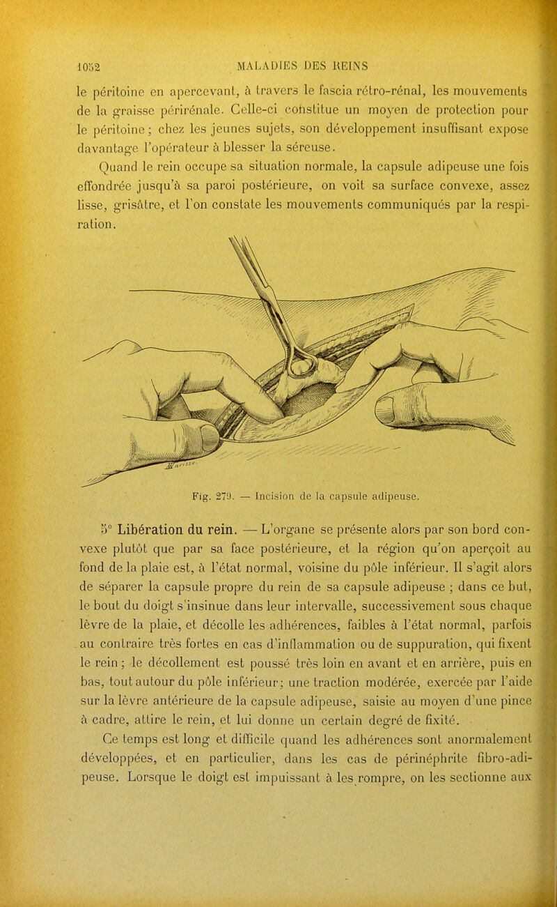 le péritoine en apercevant, à travers le fascia rétro-rénal, les mouvements de la g-raisse périrénale. Celle-ci cohstilue un moyen de protection pour le péritoine; chez les jeunes sujets, son développement insuffisant expose davantage l'opérateur à blesser la séreuse. Quand le rein occupe sa situation normale, la capsule adipeuse une fois effondrée jusqu'à sa paroi postérieure, on voit sa surface convexe, assez lisse, grisâtre, et l'on constate les mouvements communiqués par la respi- ration. Fig. 279. — Incision de la capsule adipeuse. 5° Libération du rein. — L'organe se présente alors par son bord con- vexe plutôt que par sa face postérieure, et la région qu'on aperçoit au fond de la plaie est, à l'état normal, voisine du pôle inférieur. Il s'agit alors de séparer la capsule propre du rein de sa capsule adipeuse ; dans ce but, le bout du doigt s'insinue dans leur intervalle, successivement sous chaque lèvre de la plaie, et décolle les adhérences, faibles à l'état normal, parfois au contraire très fortes en cas d'inflammation ou de suppuration, qui fixent le rein ; le décollement est poussé très loin en avant et en arrière, puis en bas, tout autour du pôle inférieur; une traction modérée, exercée par l'aide sur la lèvre antérieure de la capsule adipeuse, saisie au moyen d'une pinco à cadre, attire le rein, et lui donne un certain degré de fixité. Ce temps est long et difficile quand les adhérences sont anormalement développées, et en particulier, dans les cas de périnéphrite fibro-adi- peuse. Lorsque le doigt est impuissant à les rompre, on les sectionne aux