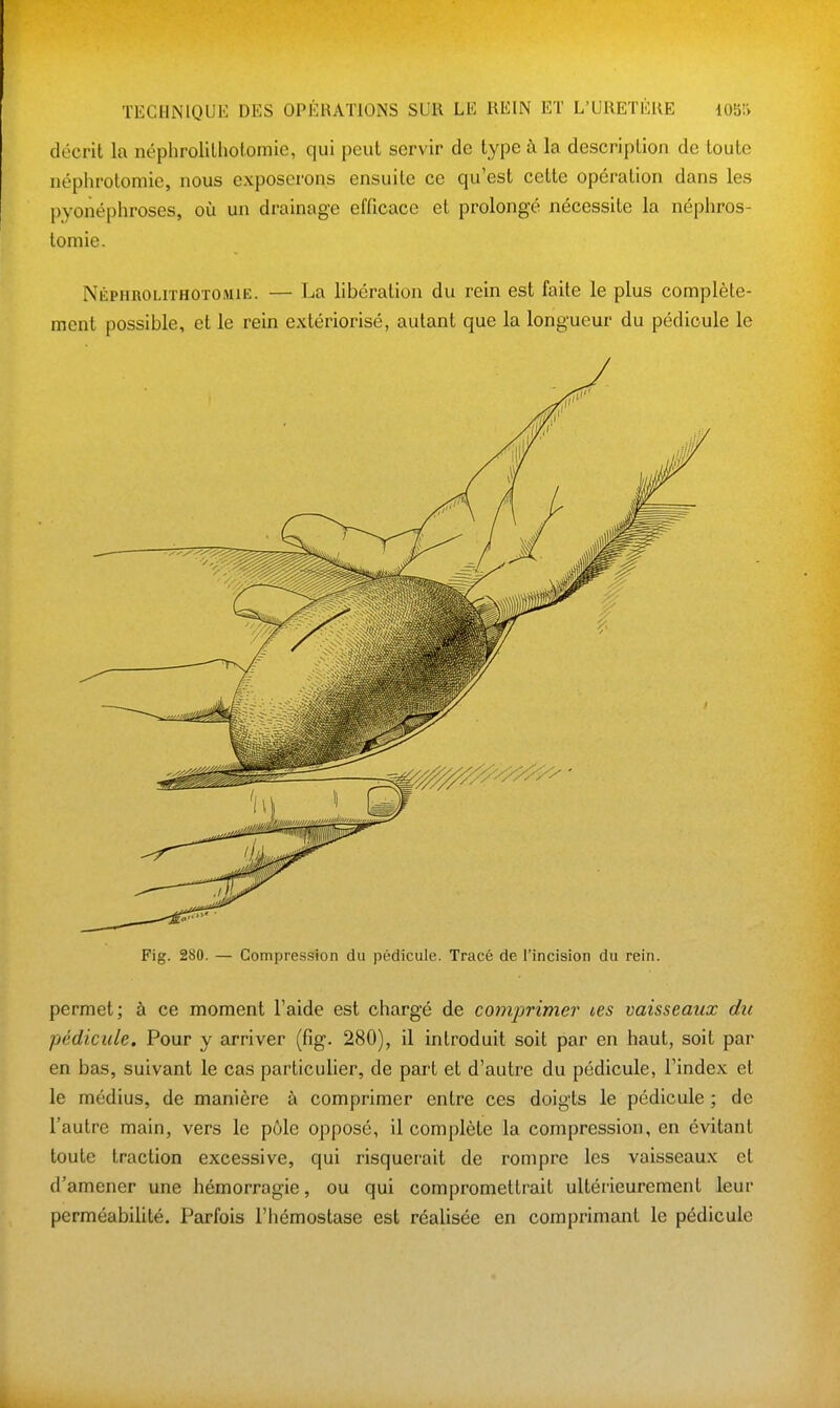 décrit la néphrolilholomic, qui peut servir de type à la description de toute népiirotomie, nous exposerons ensuite ce qu'est cette opération dans les pyonéphroses, où un drainage efficace et prolongé nécessite la néphros- tomie. NÉPHROLrrHOTOMiE. — La libération du rein est faite le plus complète- ment possible, et le rein extériorisé, autant que la longueur du pédicule le Fig. 280. — Compression du pédicule. Tracé de l'incision du rein. permet; à ce moment l'aide est chargé de comj)rimer ces vaisseaux du pédicule. Pour y arriver (fig. 280), il introduit soit par en haut, soit par en bas, suivant le cas particulier, de part et d'autre du pédicule, l'index et le médius, de manière à comprimer entre ces doigts le pédicule ; de l'autre main, vers le pôle opposé, il complète la compression, en évitant toute traction excessive, qui risquei'ait de rompre les vaisseaux et d'amener une hémorragie, ou qui compromettrait ultérieurement leur perméabilité. Parfois l'hémostase est réalisée en comprimant le pédicule