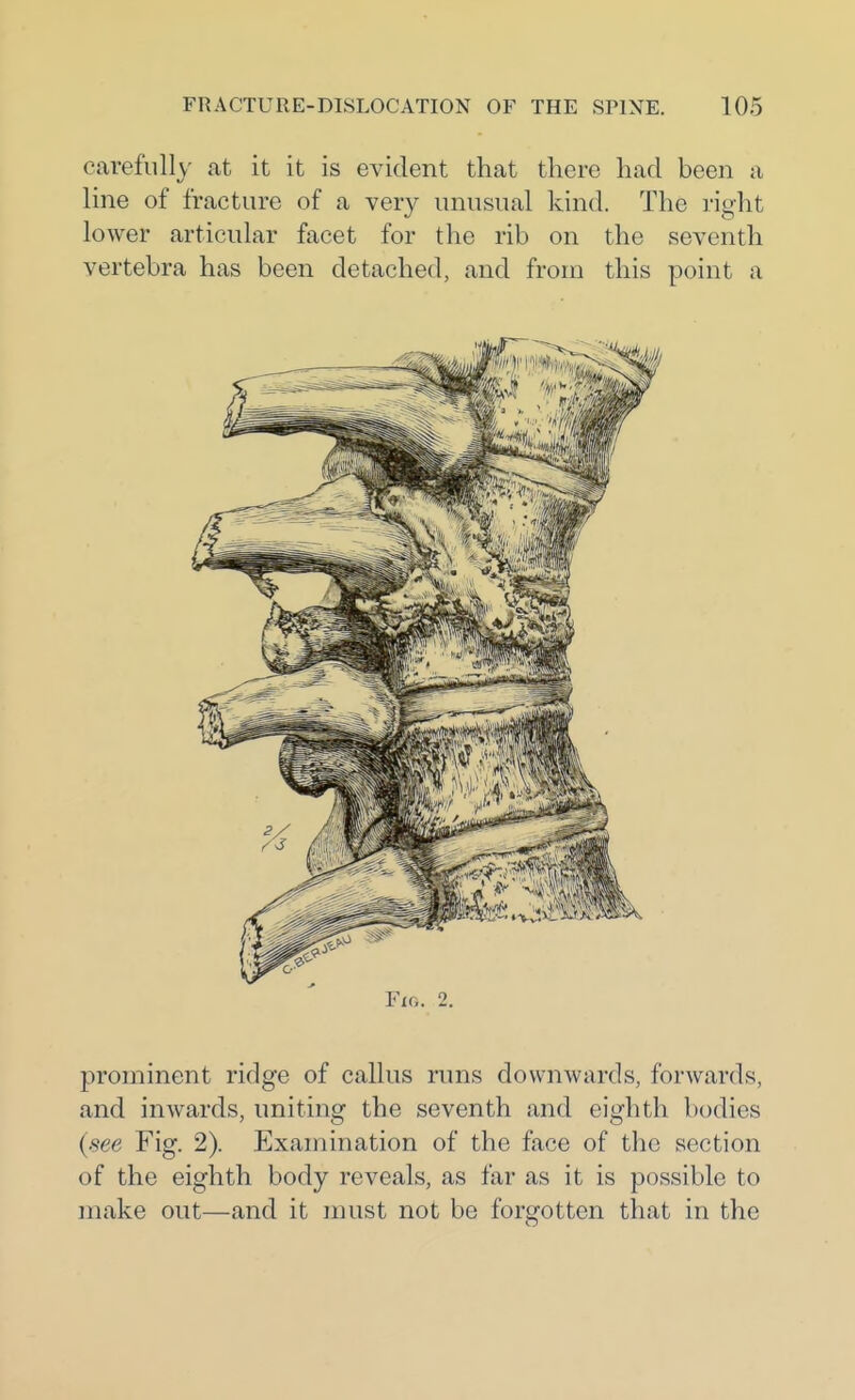 carefully at it it is evident that there had been a line of fracture of a very unusual kind. The right lower articular facet for the rib on the seventh vertebra has been detached, and from this point a Fig. 2. prominent ridge of callus runs downwards, forwards, and inwards, uniting the seventh and eighth bodies {see Fig. 2). Examination of the face of the section of the eighth body reveals, as far as it is possible to make out—and it must not be forgotten that in the