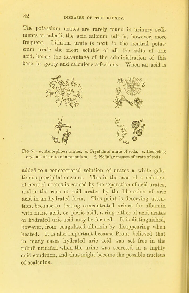 DISEASES OF THE KIDNEY. The potassium urates are rarely found in urinary sedi- ments or calculi, the acid calcium salt is, however, more frequent. Lithium urate is next to the neutral potas- sium urate the most soluble of all the salts of uric acid, hence the advantage of the administration of this base in gouty and calculous affections. When an acid is Fig- 7.—o. Amorphous urates. 6. Crystals of urate of soda. c. Hedgehog crystals of urate of ammonium, d. Nodular masses of urate of soda. added to a concentrated solution of urates a white gela- tinous precipitate occurs. This in the case of a solution of neutral urates is caused by the separation of acid urates, and in the case of acid urates by the hberation of uric acid in an hydrated form. This point is deserving atten- tion, because in testing concentrated urines for albumin with nitric acid, or picric acid, a ring either of acid urates or hydrated uric acid may be formed. It is distinguished, however, from coagulated albumin by disappearing when heated. It is also important because Prout believed that in many cases hydrated uric acid was set fi*ee in the tubuU uriniferi when the urine was secreted in a highly acid condition, and thus might become the possible nucleus of acalculus.