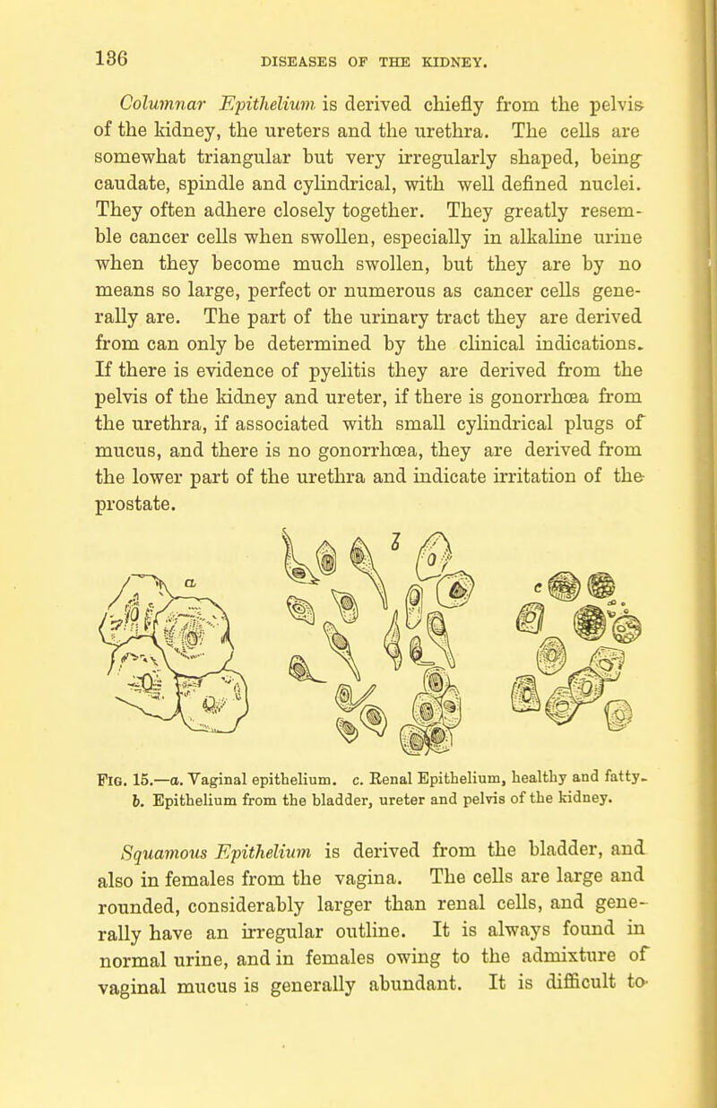 Columnar Epithelium is derived chiefly from the pelvis of the kidney, the ureters and the urethra. The cells are somewhat triangular but very irregularly shaped, being- caudate, spindle and cylindrical, with well defined nuclei. They often adhere closely together. They greatly resem- ble cancer cells when swollen, especially in alkaline urine when they become much swollen, but they are by no means so large, perfect or numerous as cancer cells gene- rally are. The part of the urinary tract they are derived from can only be determined by the cUnical indications. If there is evidence of pyelitis they are derived from the pelvis of the kidney and ureter, if there is gonorrhoea from the urethra, if associated with small cyhndrical plugs of mucus, and there is no gonorrhoea, they are derived from the lower part of the urethra and indicate irritation of the prostate. Fig. 15.—a. Vaginal epitlielium. c. Eenal Epithelium, healthy and fatty- 6. Epithelium from the bladder, ureter and pelvis of the kidney. Squamous Epithelium is derived from the bladder, and also in females from the vagina. The cells are large and rounded, considerably larger than renal cells, and gene- rally have an irregular outline. It is always found in normal urine, and in females owing to the admixture of vaginal mucus is generally abundant. It is difficult to-