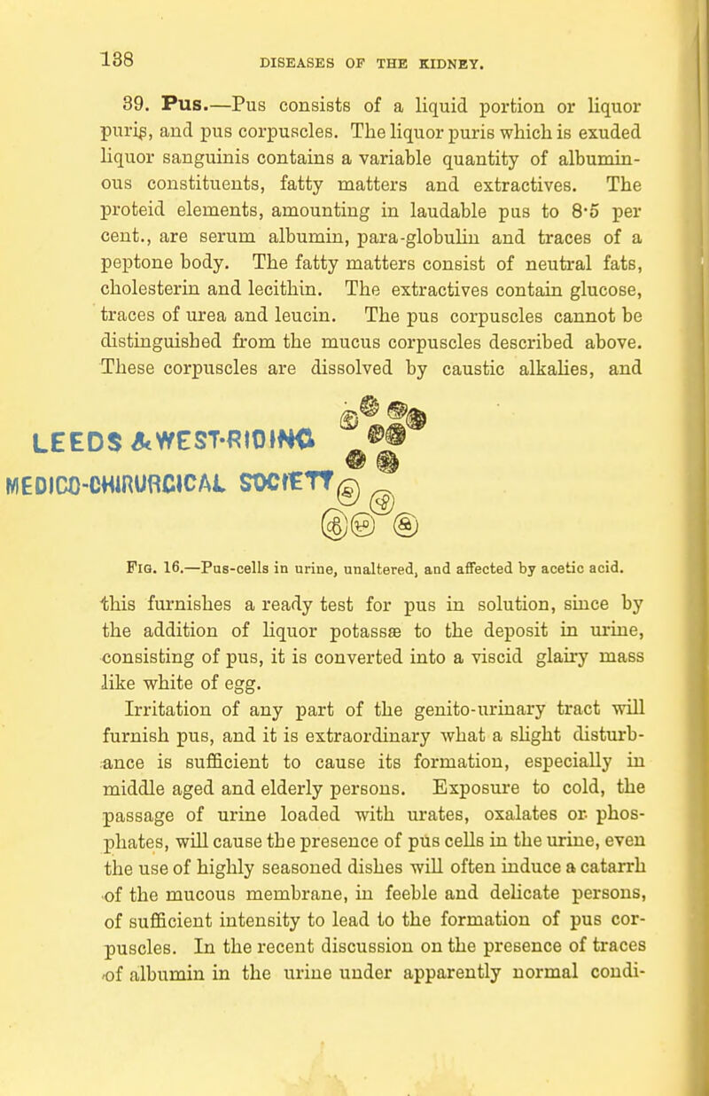 89. Pus.—Pus consists of a liquid portion or liquor puri^, and pus corpuscles. The liquor puris which is exuded liquor sanguinis contains a variable quantity of albumin- ous constituents, fatty matters and extractives. The proteid elements, amounting in laudable piis to 85 per cent., are serum albumin, para-globuhn and traces of a peptone body. The fatty matters consist of neutral fats, cholesterin and lecithin. The extractives contain glucose, traces of urea and leucin. The pus corpuscles cannot be distinguished from the mucus corpuscles described above. These corpuscles are dissolved by caustic alkaUes, and FiQ. 16.—Pus-cells in urine, unaltered, and affected by acetic acid. this furnishes a ready test for pus in solution, since by the addition of Hquor potassse to the deposit in lurine, consisting of pus, it is converted into a viscid glairy mass like white of egg. Irritation of any part of the genito-urinary tract will furnish pus, and it is extraordinary what a shght disturb- ance is sufficient to cause its formation, especially in middle aged and elderly persons. Exposure to cold, the passage of urine loaded with urates, oxalates or phos- phates, will cause the presence of pils cells in the urine, even the use of highly seasoned dishes will often induce a catarrh of the mucous membrane, in feeble and delicate persons, of sufficient intensity to lead to the formation of pus cor- puscles. In the recent discussion on the presence of traces of albumin in the urine under apparently normal condi- LEEDS AWEST-f?IO»NC MEDICO-CHiRURCICAi SOCfETfg