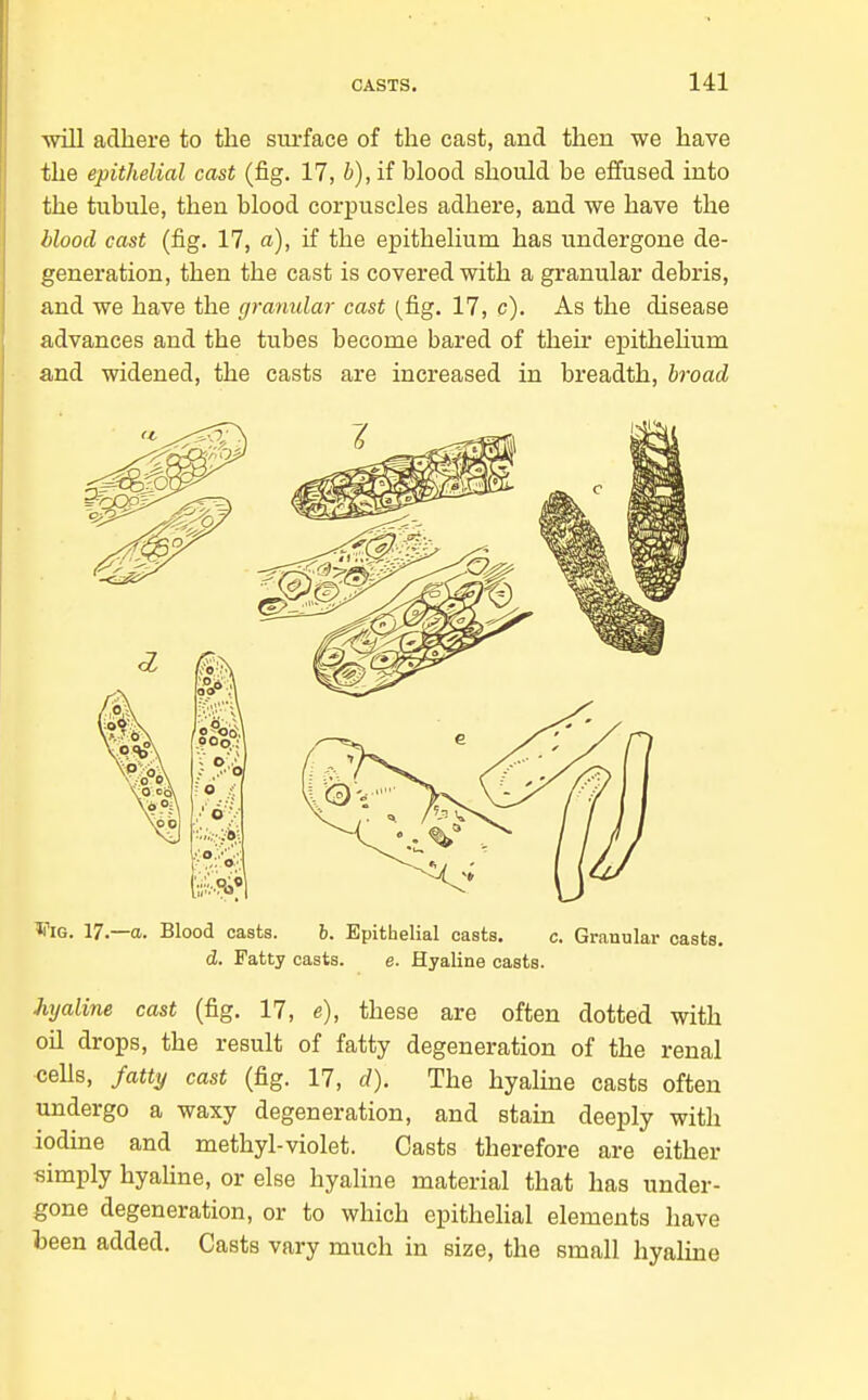 ■will adhere to the surface of the cast, and then we have the epithelial cast (fig. 17, h), if blood should be effused into the tubule, then blood corpuscles adhere, and we have the blood cast (fig. 17, a), if the epithelium has undergone de- generation, then the cast is covered with a granular debris, and we have the granular cast (^fig. 17, c). As the disease advances and the tubes become bared of their epithelium and widened, the casts are increased in breadth, hroad ViG. 17.—a. Blood casts. b. Epithelial casts. c. Granular casts. d. Fatty casts. e. Hyaline casts. hyaline cast (fig. 17, e), these are often dotted with oil drops, the result of fatty degeneration of the renal cells, fatty cast (fig. 17, d). The hyaline casts often undergo a waxy degeneration, and stain deeply with iodine and methyl-violet. Casts therefore are either simply hyaline, or else hyaline material that has under- gone degeneration, or to which epithehal elements have been added. Casts vary much in size, the small hyaline