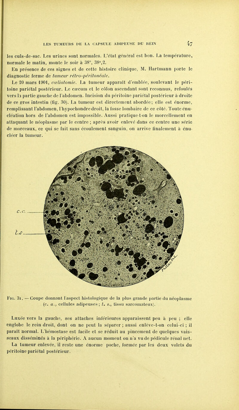 les culs-de-sac. Les urines sont normales. L'état général est bon. La température, normale le matin, monte le soir à 38°, 38°,2. En présence de ces signes et de cette histoire clinique, M. Hartmann porte le diagnostic ferme de tumeur rétro-péritonéale. Le 20 mars 1901, cœliolomie. La tumeur apparaît d'emblée, soulevant le péri- toine pariétal postérieur. Le caecum et le côlon ascendant sont reconnus, refoulés vers h partie gauche de l'abdomen. Incision du péritoine pariétal postérieur à droite de ce gros intestin (fig. 30). La tumeur est directement abordée; elle est énorme, remplissant l'abdomen, l'hypochondre droit, la fosse lombaire de ce côté. Toute énu- cléation hors de l'abdomen est impossible. Aussi pratique t-on le morcellement en attaquant le néoplasme par le centre ; après avoir enlevé dans ce centre une série de morceaux, ce qui se fait sans écoulement sanguin, on arrive finalement à énu- cléer la tumeur. Fig. 3i . — Coupe donnant l'aspect histologique de la plus grande partie du néoplasme (c. a., cellules adipeuses; /. s., tissu sarcomateux). Luxée vers la gauche, ses attaches inférieures apparaissent peu à peu ; elle englobe le rein droit, dont on ne peut la séparer ; aussi cnlève-t-on celui-ci ; il paraît normal. L'hémostase est facile et se réduit au pincement de quelques vais- seaux disséminés à la périphérie. A aucun moment on n'a vu de pédicule rénal net. La tumeur enlevée, il reste une énorme poche, formée par les deux volets du péritoine pariétal postérieur.
