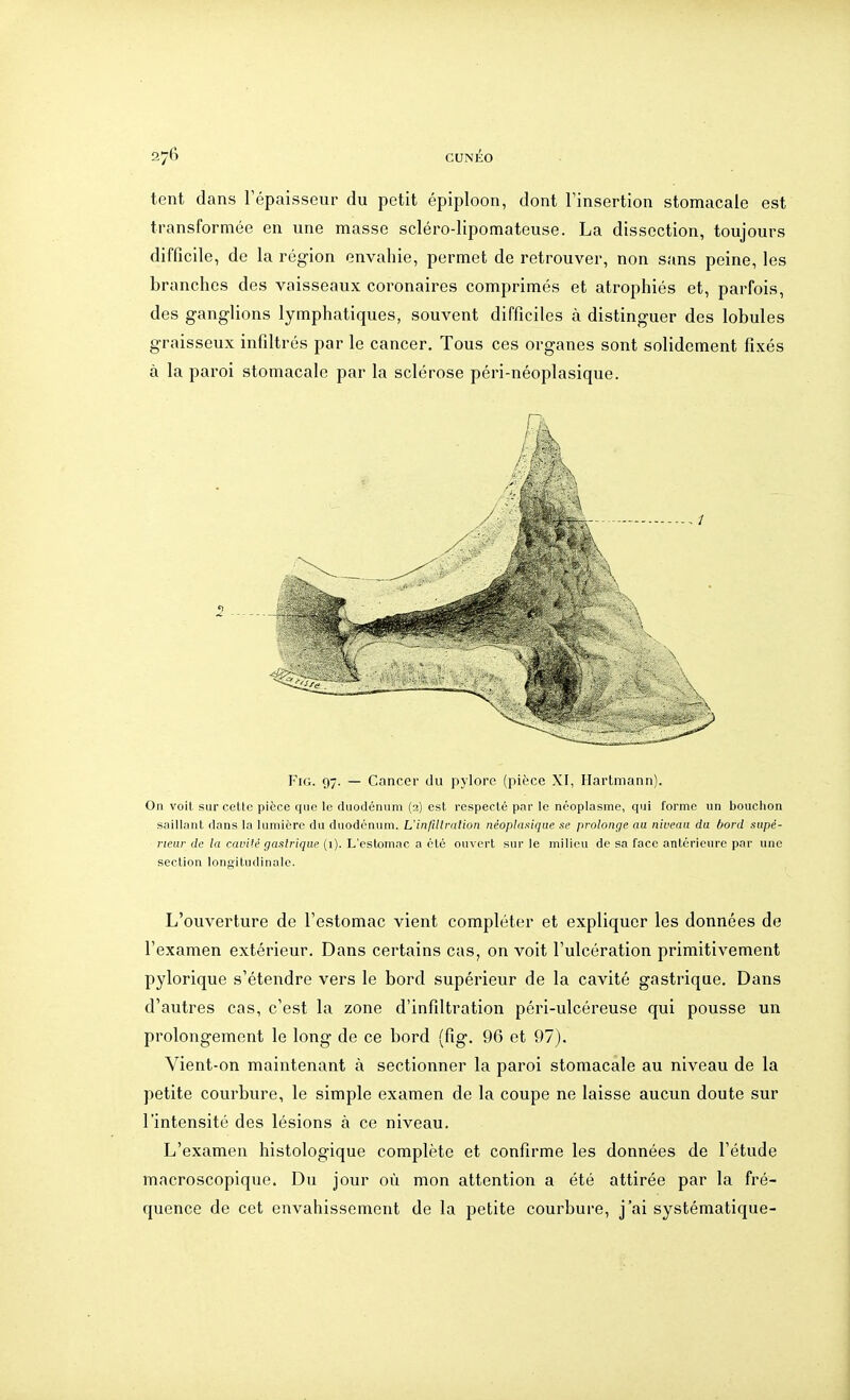 tent dans l'épaisseur du petit épiploon, dont l'insertion stomacale est transformée en une masse scléro-lipomateuse. La dissection, toujours difficile, de la région envahie, permet de retrouver, non sans peine, les branches des vaisseaux coronaires comprimés et atrophiés et, parfois, des ganglions lymphatiques, souvent difficiles à distinguer des lobules graisseux infiltrés par le cancer. Tous ces organes sont solidement fixés à la paroi stomacale par la sclérose péri-néoplasique. FiG. 97. — Cancer du pylore (pièce XI, Hartmann). On voit sur celle pièce que le duodénum (2) est respecté par le néoplasme, qui forme un bouchon saillant dans la lumière du duodénum. L'infiUralion néoplaaique se prolonge au niveau du bord supé- riear de la cavité gastrique (1). L'estomac a été ouvert sur le milieu de sa face antérieure par une section longitudinale. L'ouverture de l'estomac vient compléter et expliquer les données de l'examen extérieur. Dans certains cas, on voit l'ulcération primitivement pylorique s'étendre vers le bord supérieur de la cavité gastrique. Dans d'autres cas, c'est la zone d'infiltration péri-ulcéreuse qui pousse un prolongement le long de ce bord (fig. 96 et 97). Vient-on maintenant à sectionner la paroi stomacale au niveau de la petite courbure, le simple examen de la coupe ne laisse aucun doute sur l'intensité des lésions à ce niveau. L'examen histologique complète et confirme les données de l'étude macroscopique. Du jour où mon attention a été attirée par la fré- quence de cet envahissement de la petite courbure, j'ai systématique-