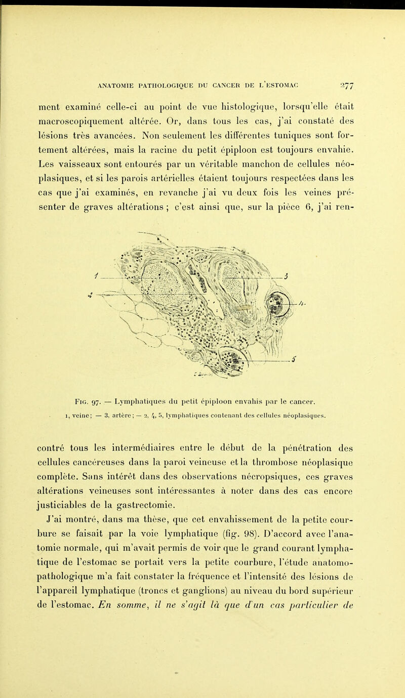 ment examiné celle-ci au point de vue histologique, lorsqu'elle était macroscopiquement altérée. Or, dans tous les cas, j'ai constaté des lésions très avancées. Non seulement les différentes tuniques sont for- tement altérées, mais la racine du petit épiploon est toujours envahie. Les vaisseaux sont entourés par un véritable manchon de cellules néo- plasiques, et si les parois artérielles étaient toujours respectées dans les cas que j'ai examinés, en revanche j'ai vu deux fois les veines pré- senter de graves altérations ; c'est ainsi que, sur la pièce 6, j'ai ren- FiG. 97. — Lymphatiques du petit épiploon envahis par le cancer. 1, veine; — 3, artère; — 2, t,, 5, lymphnliques contenant des cellules néoplasiqiies. contré tous les intermédiaires entre le début de la pénétration des cellules cancéreuses dans la paroi veineuse et la thrombose néoplasique complète. Sans intérêt dans des observations nécropsiques, ces graves altérations veineuses sont intéressantes à noter dans des cas encore justiciables de la gastrectomie. J'ai montré, dans ma thèse, que cet envahissement de la petite cour- bure se faisait par la voie lymphatique (fig. 98). D'accord avec l'ana- tomie normale, qui m'avait permis de voir que le grand courant lympha- tique de l'estomac se portait vers la petite courbure, l'étude anatomo- pathologique m'a fait constater la fréquence et l'intensité des lésions de l'appareil lymphatique (troncs et ganglions) au niveau du bord supérieur de l'estomac. En somme, il ne s'agit là que d'un cas paiiiculier de