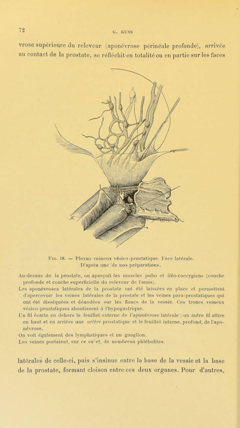 G. KUSS vrose supérieure du releveur (aponévrose périnéale profonde), arrivée au contact de la prostate, se réfléchit en totalité ou en partie sur les faces FiG. 18. — Plexus veineux vésico-proslatique. Face latérale. D'après une de nos préparations. Au-dessus de la prostate, on aperçoit les muscles pubo et iléo-coccj'giens (couche profonde et couche superficielle du releveur de l'anus). Les aponévroses latérales de la prostate ont été laissées en place et permettent d'apercevoir les veines latérales de la prostate et les veines para-prostatiques qui ont été disséquées et déundées sur les flancs de la vessie. Ces troncs veineux vésico-prostatiques aboutissent à l'hypogastrique. Un fil écarte en dehors le feuillet externe de l'aponévrose latérale : un autre fil attire en haut et en arrière une artère prostatique et le feuillet interne, profond, de l'apo- névrose. On voit également des lymphatiques et un ganglion. Les veines portaient, sur ce su'et, de nombreux phléboliles. latérales de celle-ci, puis s'insinue entre la base de la vessie et la base de la prostate, formant cloison entre ces deux organes. Pour d'autres.