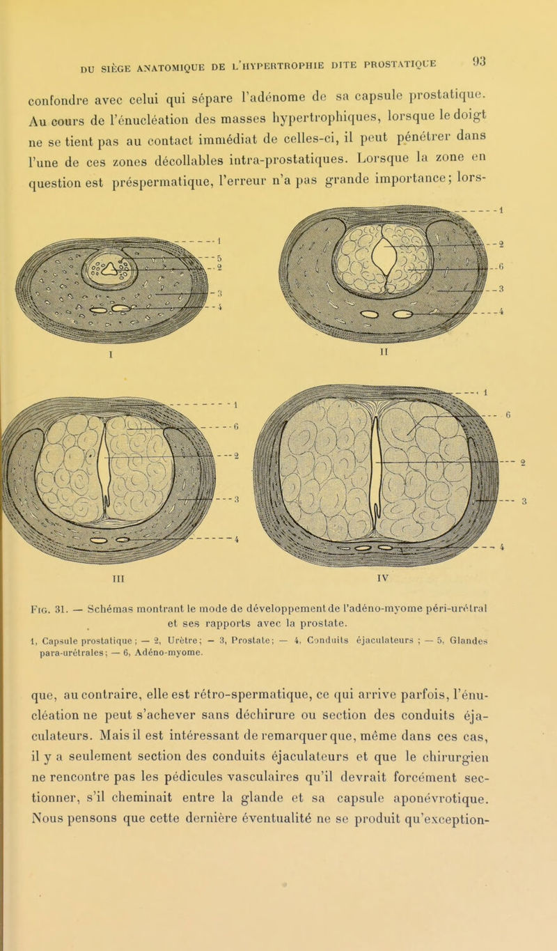 confondre avec celui qui sépare l'adénome de sa capsule prostatique. Au cours de l'énucléation des masses hypertrophiques, lorsque le doigt ne se tient pas au contact immédiat de celles-ci, il peut pénétrer dans l'une de ces zones décollables intra-prostatiques. Lorsque la zone en question est préspermatique, l'erreur n'a pas grande importance; lors- 11 - — 2 - - 4 m IV FrG. 31. — Schémas montrant le mode de développement de l'adéno-myome péri-urélral et ses rapports avec la prostate. 1, Capsule prostatique; — 2, Urètre; - 3, Prostate; — 4, Conduits éjaculaleurs ; — 5, Glandes para-urélrales; — 6, Adéno-myome. que, au contraire, elle est rétro-spermatique, ce qui arrive parfois, l'énu- cléation ne peut s'achever sans déchirure ou section des conduits éja- culateurs. Mais il est intéressant de remarquer que, même dans ces cas, il y a seulement section des conduits éjaculaleurs et que le chirurgien ne rencontre pas les pédicules vasculaires qu'il devrait forcément sec- tionner, s'il cheminait entre la glande et sa capsule aponévrotique. Nous pensons que cette dernière éventualité ne se produit qu'exception-