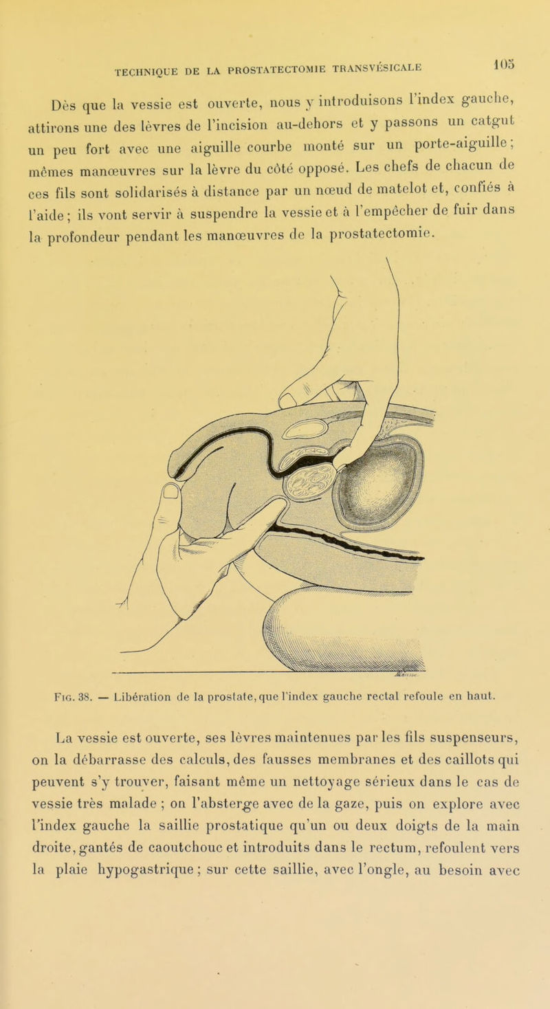 Dès que la vessie est ouverte, nous y introduisons l'index gauche, attirons une des lèvres de l'incision au-dehors et y passons un catgut un peu fort avec une aiguille courbe monté sur un porte-aiguille ; mômes manœuvres sur la lèvre du côté opposé. Les chefs de chacun de ces fils sont solidarisés à distance par un nœud de matelot et, confiés à l'aide ; ils vont servir à suspendre la vessie et à l'empêcher de fuir dans la profondeur pendant les manœuvres do la prostatectomie. FiG. 38. — Libération de la prostate, que l'index gauche rectal refoule en haut. La vessie est ouverte, ses lèvres maintenues pai-les fils suspenseurs, on la débarrasse des calculs, des fausses membranes et des caillots qui peuvent s'y trouver, faisant même un nettoyage sérieux dans le cas de vessie très malade ; on l'abster^e avec de la gaze, puis on explore avec l'index gauche la saillie prostatique qu'un ou deux doigts de la main droite, gantés de caoutchouc et introduits dans le rectum, refoulent vers la plaie hypogastrique ; sur cette saillie, avec l'ongle, au besoin avec