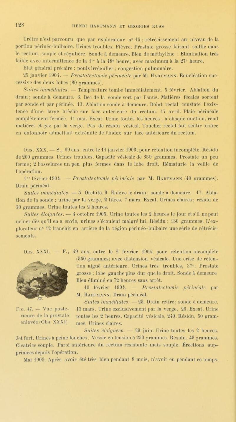 Urètre n'est parcouru que par explorateur n° 15 ; rétrécissemeul au niveau de la portion périnéo-bulbaire. Urines troubles. Fièvre. Prostate grosse faisant saillie dans le rectum, souple et régulière. Sonde à demeure. Bleu de méthylène : Elimination très faible avec intermittence de la l à la 48« heure, avec maximum à la ^T'' heure. Etat général précaire : pouls irrégulier ; congestion pulmonaire. 25 janvier 190i. — Proslalectomie périnéale par M. Hartmann. Enucléation suc- cessive des deux lobes 80 grammes». Suites immédiales. — Température toml)e immédiatement. 5 février. Ablation du drain ; sonde à demeure. 6. Bec de la sonde sort par l'anus. Matières fécales sortent par sonde et par périnée. 18. Ablation sonde à demeure. Doigt rectal constate l'exis- tence d'une large brèche sur face antérieure du rectum, il avril. Plaie périnéale complètement fermée. 11 mai. Exeat. Urine toutes les heures ; à chaque miction, rend matières et gaz par la verge. Pas de résidu vésical. Toucher rectal fait sentir orifice en entonnoir admettant extrémité de l'index sur face antérieure du rectum. Obs. XXX. — S., 69 ans, entre le 14 janvier 1903, pour rétention incomplète. Résidu de 200 grammes. Urines troubles. Capacité vésicale de 350 grammes. Prostate un peu ferme; 2 bosselures un peu plus fermes dans le lobe droit. Hématurie la veille de l'opération. l*' février 1904. —Proslaleclomie périnéale par M. Hartmann (40 grammes). Drain périnéal. Suilea immédiales. — 5. Orchite. 9. Enlève le drain; sonde à demeure. 17. Abla- tion de la sonde ; urine par la verge, 2 litres. 7 mars. Exeat. Urines claires ; résidu de 20 grammes. Urine toutes les 2 heures, Suiles éloignées-. — 4 octobre 1905. Urine toutes les 2 heures le jour et s'il ne peut uriner dès qu'il en a envie, urines s'écoulent malgré lui. Résidu : 150 grammes. L'ex- plorateur n 12 franchit en arrière de la région péi'inéo-I)ulbaire une série de rétrécis- sements. Obs. XXX]. — F., 49 ans, entre le 2 février 1904, pour rétention incomplète (550 grammes) avec distension vésicale. Une crise de réten- tion aiguë antérieure. Urines très troubles, 37. Prostate grosse ; lobe gauche plus dur que le droit. Sonde à demeure Bleu éliminé en 72 heures sans arrêt. 19 février 1904. — Proslaleclomie périnéale par M. Hartmann. Drain périnéal. Suiles immédiales. —25. Drain retiré; sonde à demeure. 13 mars. Urine exclusivement par la verge. 26. Exeat. Urine toutes les 2 heures. Capacité vésicale, 240. Résidu, 50 gram- mes. Urines claires. Suiles éloignées. — 29 juin. Urine toutes les 2 heures. Jet fort. Urines à peine louches. Vessie en tension à 230 grammes. Résidu, 45 grammes. Cicatrice souple. Paroi antérieure du rectum résistante mais souple. Érections sup- primées depuis l'opération. Mai 1905. Après avoir été très bien pendant 8 mois, n'avoir eu pendant ce temps, FiG. 47. — Vue posté- rieure de la prostate enlevée (Obs. XXXI).