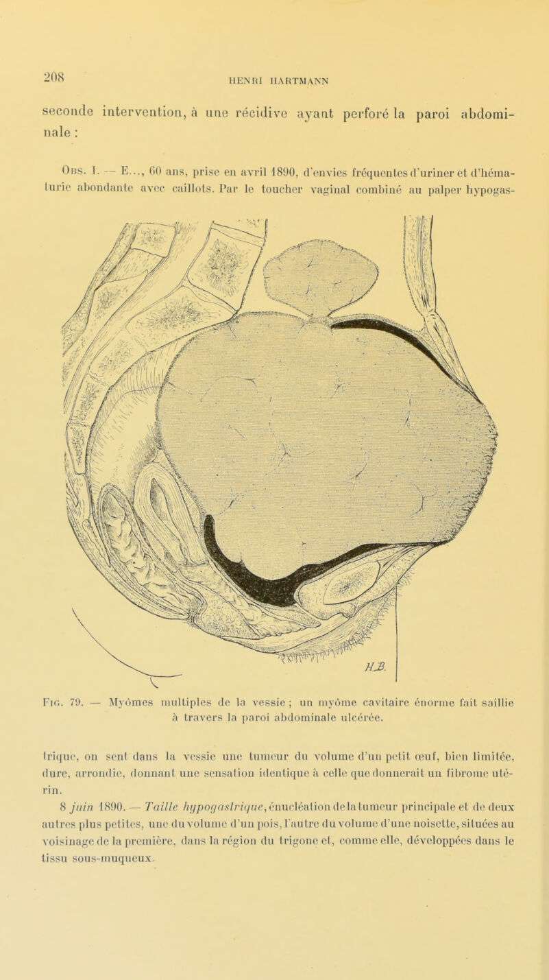 -«^ HENRI HARTMANN seconde intervention, à une récidive ayant perforé la paroi abdomi- nale : Obs. I. — E..., fiO ans, prise en avril 1890, d'envies fréquentes d'uriner et d'héma- turie abondante avec caillots. Par le toucher vaginal combiné au palper hypogas- Fir.. 79. — Myùmes nuilliples de la vessie ; un inyôme cavilaire énonnc fait saillie à travers la paroi abdominale ulcérée. tri(jue, on seni dans la vessie une Innienr du volume d'un petit œnf, bien limitée, dure, arrondie, donnant une sensation identique à celle que donnerait un fibrome uté- rin. 8 juin 1890.— Taille /jypor/a.ç//'/(///^',énucléalion delà tumeur principale et de deux autres plus petites, une du volume d'un pois, l'autre du volume d'une noisette, situées au voisinage de la première, dans la région du trigone et, comme elle, développées dans le tissu sous-muqueux.