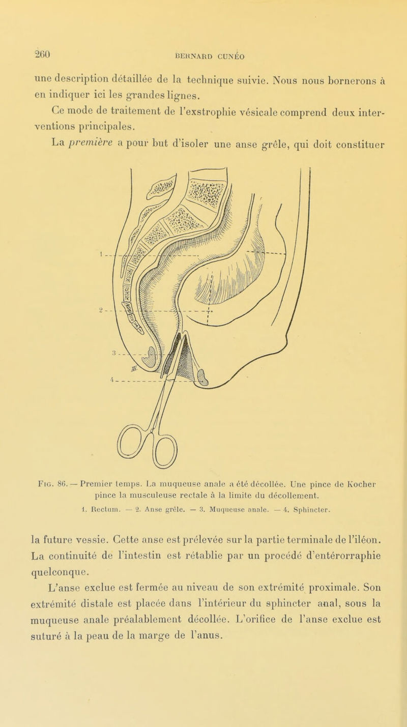 une description détaillée de la technique suivie. Nous nous bornerons à en indiquer ici les grandes lignes. Ce mode de traitement de l'exstropliie vésicale comprend deux inter- ventions principales. La première a pour but d'isoler une anse grêle, qui doit constituer FiG. 80. — Premier temps. La muqueuse anale a été décollée. Une pince de Kocher pince la musculeuse rectale à la limite du décollement. 1. Rectum. — 2. Anse grêle. — 3. Miirineiise anale. — 4. Sphincter. la future vessie. Cette anse est prélevée sur la partie terminale de l'iléon. La continuité de l'intestin est rétablie par un procédé d'entérorraphie quelconque. L'anse exclue est fermée au niveau de son extrémité proximale. Son extrémité distale est placée dans l'intérieur du sphincter anal, sous la muqueuse anale préalablement décollée. L'orifice de l'anse exclue est suturé à la peau de la marge de l'anus.