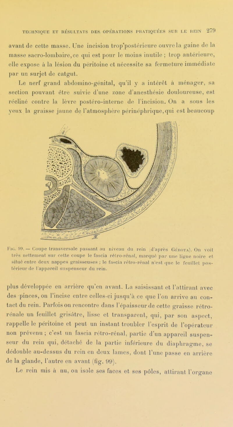 avant de cette masse. Une incision trop'postôrieure ouvre la gaine de la masse sacro-lombaire,ce qui est pour le moins inutile ; trop antérieure, elle expose à la lésion du péritoine et nécessite sa fermeture immédiate pai' un surjet de catgut. Le nerf grand abdomino-génital, qu'il y a intérêt à ménager, sa section pouvant être suivie d'une zone d'anestliésie douloureuse, est récliné contre la lèvre postéro-interne de l'incision. On a sous les yeux la graisse jaune de ratmosplière périnéplii ique,qui est beaucoup I'k,. '.lit. — Coupe Iransvcrsale passant au niveau du rein ^d'après Gkrota). On voit Irrs noiteinont sur celte coupe le Cascia rélro-rénai, nianjuc pai- une li^ne noire el i^itué entre deux napi)es graisseuses ; le l'ascia rélro-rénal n'est ([ue le feuillet ])Os- lérieurde l'appareil suspenseur du rein. plus développée en arrière qu'en avant. La saisissant et l'attirant avec des pinces, on l'incise entre celles-ci jusqu'à ce que l'on arrive au con- tact du rein. Parl'ois on rencontre dans l'épaisseur de cette graisse rétro- rénale un feuillet grisâtre, lisse et transparent, qui, par son aspect, rappelle le péritoine et peut un instant tioubler l'esprit de l'opérateur non prévenu ; c'est un l'ascia rétro-rénal, partie d'un appareil suspen- seur du rein ([ui, détaché de la partie inférieure du diaphragme, se dédouble au-dessus du rein en deux lames, dont l'une passe en arrière de la glande, l'autre en avant (lig. 99). Le rein mis à nu, ou isole ses faces et ses pôles, attirant l'organe