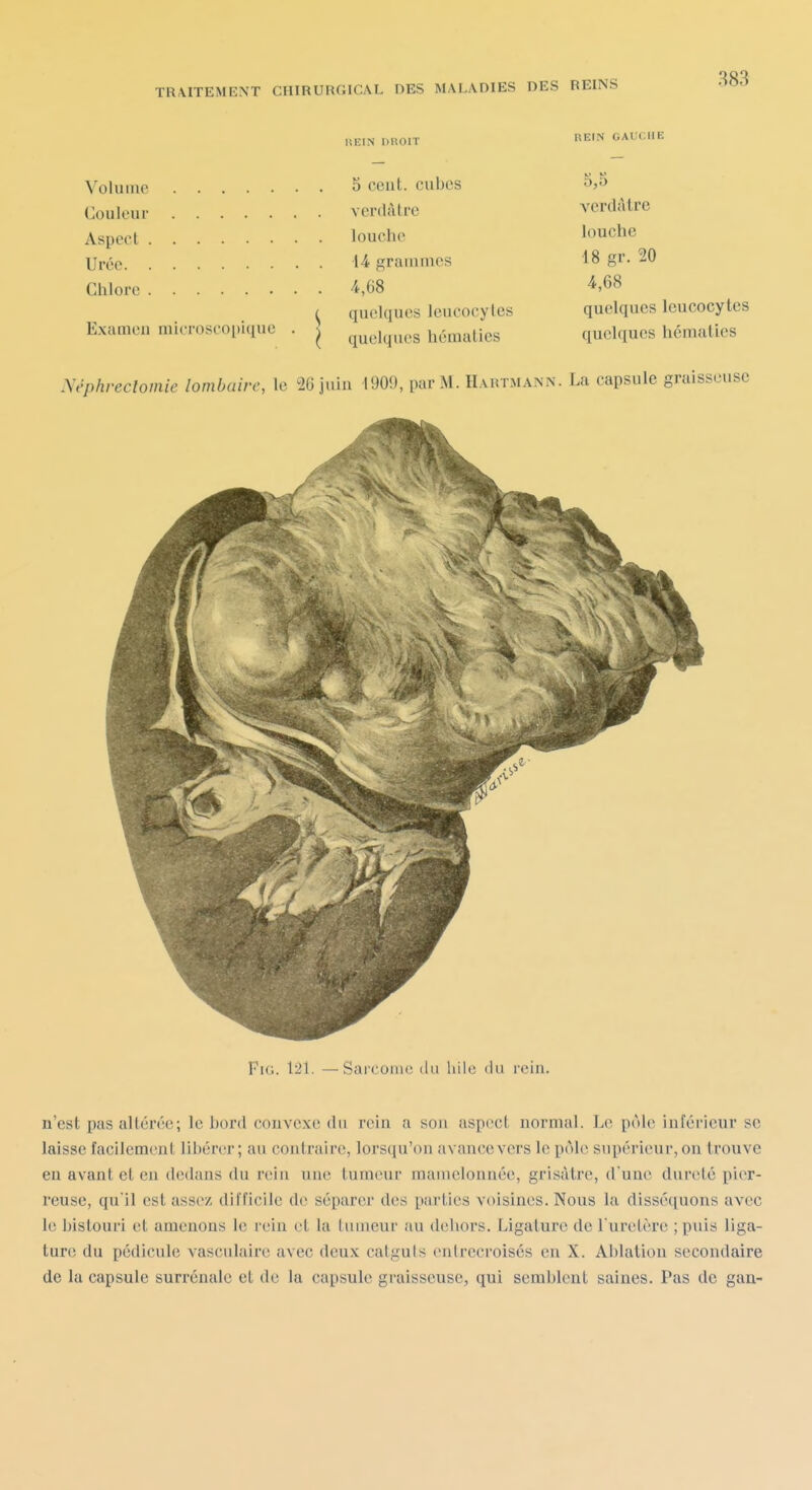 Volume Couleur Aspect Urée Chlore Examen microscopique Néphreclomie lombaire, le 26 juin 1909, par M. Hartmann. La capsule graisscu FiG. \2\. —Sarcome du liile du rein. 5 cent, cubes verdàtre louche 14 grammes 4,68 quelques leucocytes quelques hématies 5,5 verdàtre louche 18 gr. 20 4,68 quelques leucocytes quelques hématies n'est pas altérée; le bord convexe du rein a son aspect normal. Le pôle inférieur se laisse facilemeul libérer; au contraire, lorsqu'on avance vers le pôle supérieur, on trouve en avant et en dedans du rein une tumeur mamelonnée, grisâtre, d'une dureté pier- reuse, qu'il est assez difficile de séparer des parties voisines. Nous la disséquons avec le bistouri et amenons le rein et la tumeur au dehors. Ligature de l'uretère ; puis liga- ture du pédicule vasculairc avec deux catguts entrecroisés en X. Ablation secondaire de la capsule surrénale et de la capsule graisseuse, qui semblent saines. Pas de gan-