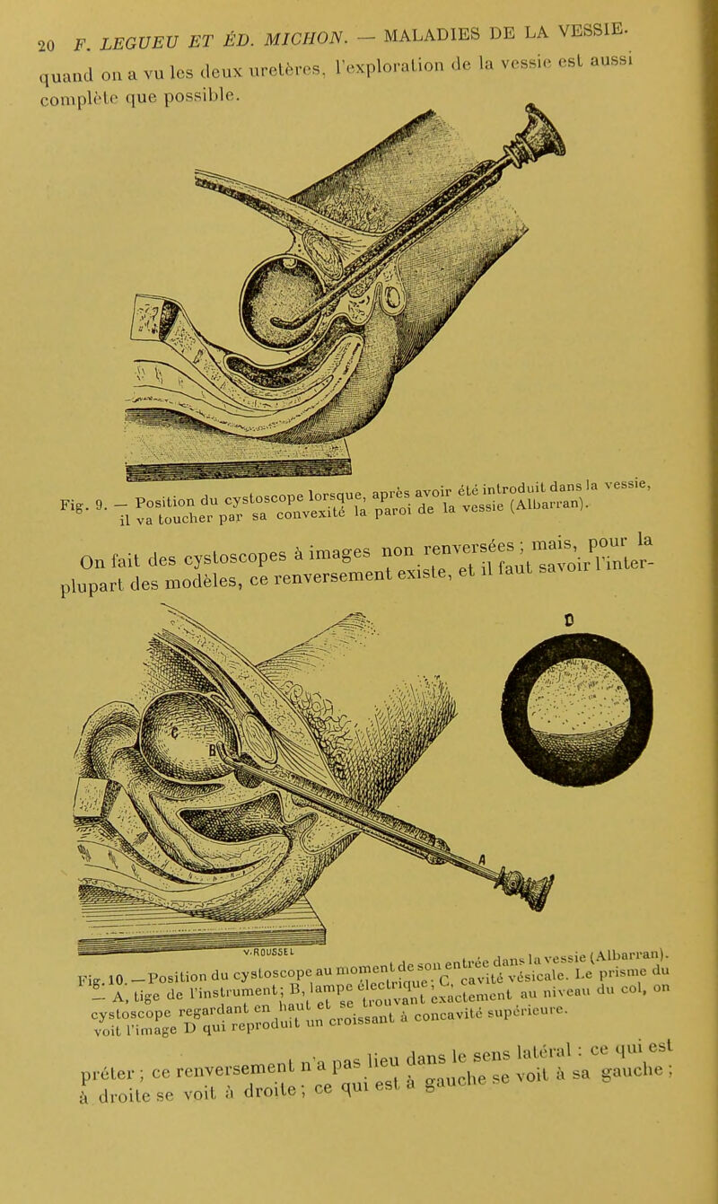 quaad ou a vu les deux uretères, l'exploralion de la vessie est aussi complète que possible. 0„ fait des csloscopes à images ^^^^^^^JZ^ plupart des modèles, ce renversement existe, et .1 laut Kig 10 -Position du cystoscope au ..on.c^de^-J^^^ ,i pnsn,e du !: A tige de l'insfument; », a^e e ec 3^ niveau du col. on ^S^^^^^od^— ^ concavit. sup..eu.e. p.aer ; ce renverse.eut n'a pas 1^ dans le^n. ^f^^^:^ r droite se voit à droite; ce qm est a gaucUe