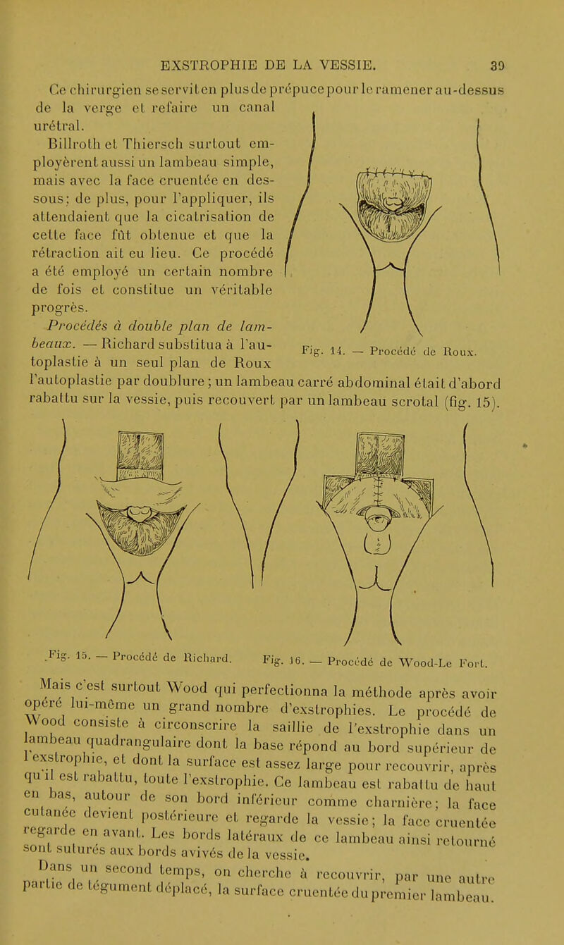 Ce chirurgien seservilen plusdeprépucepourlcramenerau-dessus de la verge et refaire un canal urélral. Billroth et Thiersch surtout em- ployèrent aussi un lambeau simple, mais avec la face cruentée en des- sous; de plus, pour l'appliquer, ils attendaient que la cicatrisation de cette face fût obtenue et que la rétraction ait eu lieu. Ce procédé a été employé un certain nombre de fois et constitue un véritable progrès. Procédés à double plan de lam- beaux. — Richard substitua à l'au- toplastie à un seul plan de Roux Fautoplastie par doublure ; un lambeau carré abdominal était d'abord rabattu sur la vessie, puis recouvert par un lambeau scrotal (fig. 15). Fig. 14. — Procédé de Roux. .Fig. 15. — Procédé de Richard. Fig. 16. Procédé de Wood-Le ForL Mais C'est surtout Wood qui perfectionna la méthode après avoir opéré lui-même un grand nombre d'exstrophies. Le procédé de Wood consiste à circonscrire la saillie de l'exstrophie dans un ambeau quadrangulaire dont la base répond au bord supérieur de 1 exstrophie, et dont la surface est assez large pour recouvrir, après qui est rabattu, toute l'exslrophie. Ce lambeau est rabaitu de haut en bas, autour de son bord inférieur comme charnière; la face cutanée devient postérieure et regarde la vessie; la face cruenlée regarde en avant. Les bords latéraux de ce lambeau ainsi retourné sont sutures aux bords avivés de la vessie. Dans un second temps, on cherche à recouvrir, par une autre partie de tégument déplacé, la surface cruentée du p;eLer lamC.