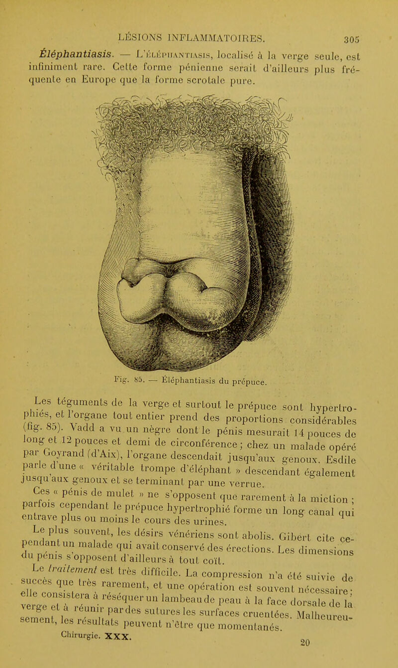 Éléphantiasis. — L'élépiiantiasis, localisé à la verge seule, est infiuiment rare. Cette forme pénienne serait d'ailleurs plus fré- quente en Europe que la forme scrotale pure. Fig-. 85. — Éléphantiasis du prépuce. Les téguments de la verge et surtout le prépuce sont hypertro- phiés et l'organe tout entier prend des proportions considérables hg. 8o) Vadd a vu un nègre dont le pénis mesurait 14 pouces de long et 12 pouces et demi de circonférence; chez un malade opéré par GoyrandfdAix), l'organe descendait jusqu'aux genoux. Esdile parle dune « véritable trompe d'éléphant » descendant également jusqu aux genoux et se terminant par une verrue Ces « pénis de mulet » ne s'opposent que rarement à la miction • parfois cependant le prépuce hypertrophié forme un long canal qui entrave plus ou moins le cours des urines. ^ Le plus souvent, les désirs vénériens sont abolis. Giberl cite ce pendant un malade qui avait conservé des érections. Les dimensions du penis s opposent d'ailleurs à tout coït Le Iraitcnent est très difficile. La compression n'a été suivie de dirdSera 1 ^^''^ '\ ^ ^^^^^ ni- elle consiste a a réséquer un lambeau de peau à la face dorsale de la verge et à réunir par des sutures les surfaces cruenlées. Malheu eu sèment, les résultats peuvent n'être que momentanés.
