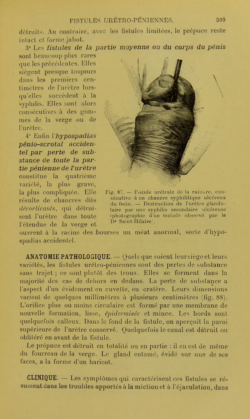 dcHruiU: Au conlraire, avec les fislulos limitées, le prépuce reste intact et Ibniic jabot. 3° Les fistules de la partie moyenne ou du corps du pénis sont beaucoup plus rares que les prcccdcntcs. Elles siègent presque toujours dans les premiers cen- timètres (le l'urètre lors- qu'elles succèdent à la syphilis. Elles sont alors consécutives à des gom- mes de la verge ou de l'urètre. 4° Enfin Vliypospadias pénio-scrotal acciden- tel par perte de sub- stance de toute la par- tie pénienne de l'urètre constitue la quatrième variété, la plus grave, la plus compliquée. Elle résuite de chancres dits décorlicanls, qui détrui- sent l'urètre dans toute l'étendue de la verge et ouvrent à la racine des bourses un méat anormal, sorte d'hypo- spadias accidentel. ANATOMIE PATHOLOGIQUE. — Quels que soient leur&iègoet leurs variétés, les fistules urétro-péniennes sont des pertes de .substance sans trajet; cesontplulôt des trous. Elles se forment dans la majorité des cas de dehors en dedans. La perte de substance a l'aspect d'un évidement en cuvette, en cratère. Leurs dimensions varient de quelques millimètres à plusieurs centimètres (fig. 88). L'orifice plus ou moins circulaire est formé par une membrane de nouvelle formation, lisse, épiderinisée et mince. Les bords sont quelquefois calleux. Dans le fond de la fistule, on aperçoit la paroi supérieure de l'urètre conservé. Quelquefois le canal est détruit ou oblitéré en avant de la fistule. Le prépuce est détruit en totalité ou en partie : il en est de même du fourreau de la verge. Le gland entamé, évidé sur une de ses faces, a la forme d'un haricot. CLINIQUE. — Les symptômes qui caractérisent ces fistules se ré- sument dans les troubles apportés à la miction et à l'éjaculation, dans Fig. 87. — FisLule urétrale de la rainure, con- sécutive - à un chancre syphilitique ulcéreux du frein. — Destruction de l'urètre glandu- laire par une syphilis secondaire ulcéreuse (photographie d'un malade observé par le D' Saint-Hilaire).