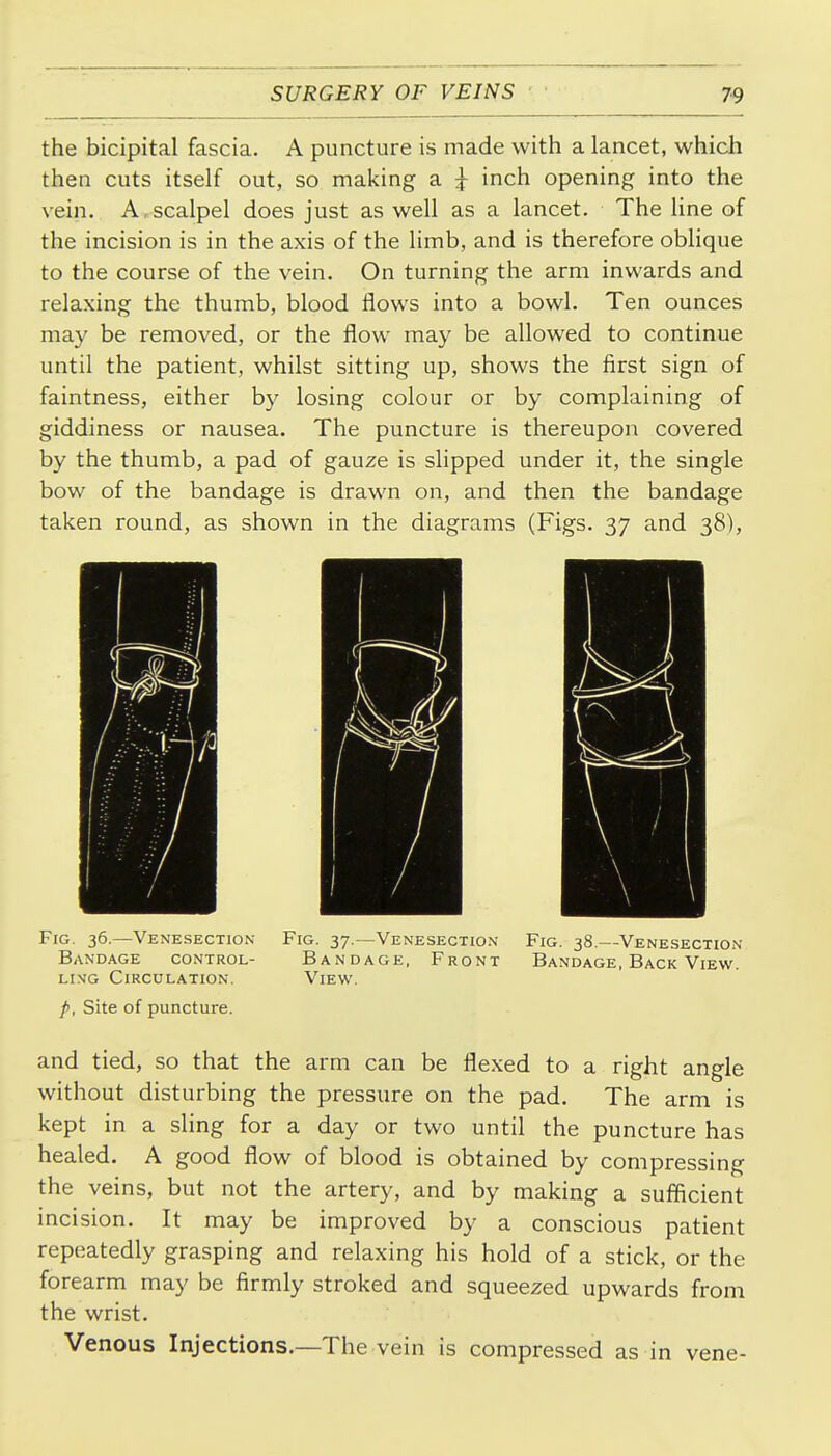 the bicipital fascia. A puncture is made with a lancet, which then cuts itself out, so making a ^ inch opening into the vein. A,scalpel does just as well as a lancet. The line of the incision is in the axis of the hmb, and is therefore oblique to the course of the vein. On turning the arm inwards and relaxing the thumb, blood flows into a bowl. Ten ounces may be removed, or the flow may be allowed to continue until the patient, whilst sitting up, shows the first sign of faintness, either by losing colour or by complaining of giddiness or nausea. The puncture is thereupon covered by the thumb, a pad of gauze is slipped under it, the single bow of the bandage is drawn on, and then the bandage taken round, as shown in the diagrams (Figs. 37 and 38), Fig. 36.—Venesection Fig. 37.—Venesection Fig. 38.—Venesection Bandage control- Bandage, Front Bandage, Back View. Li\G Circulation. View. p, Site of puncture. and tied, so that the arm can be flexed to a right angle without disturbing the pressure on the pad. The arm is kept in a sling for a day or two until the puncture has healed. A good flow of blood is obtained by compressing the veins, but not the artery, and by making a sufficient incision. It may be improved by a conscious patient repeatedly grasping and relaxing his hold of a stick, or the forearm may be firmly stroked and squeezed upwards from the wrist. Venous Injections.—The vein is compressed as in vene-