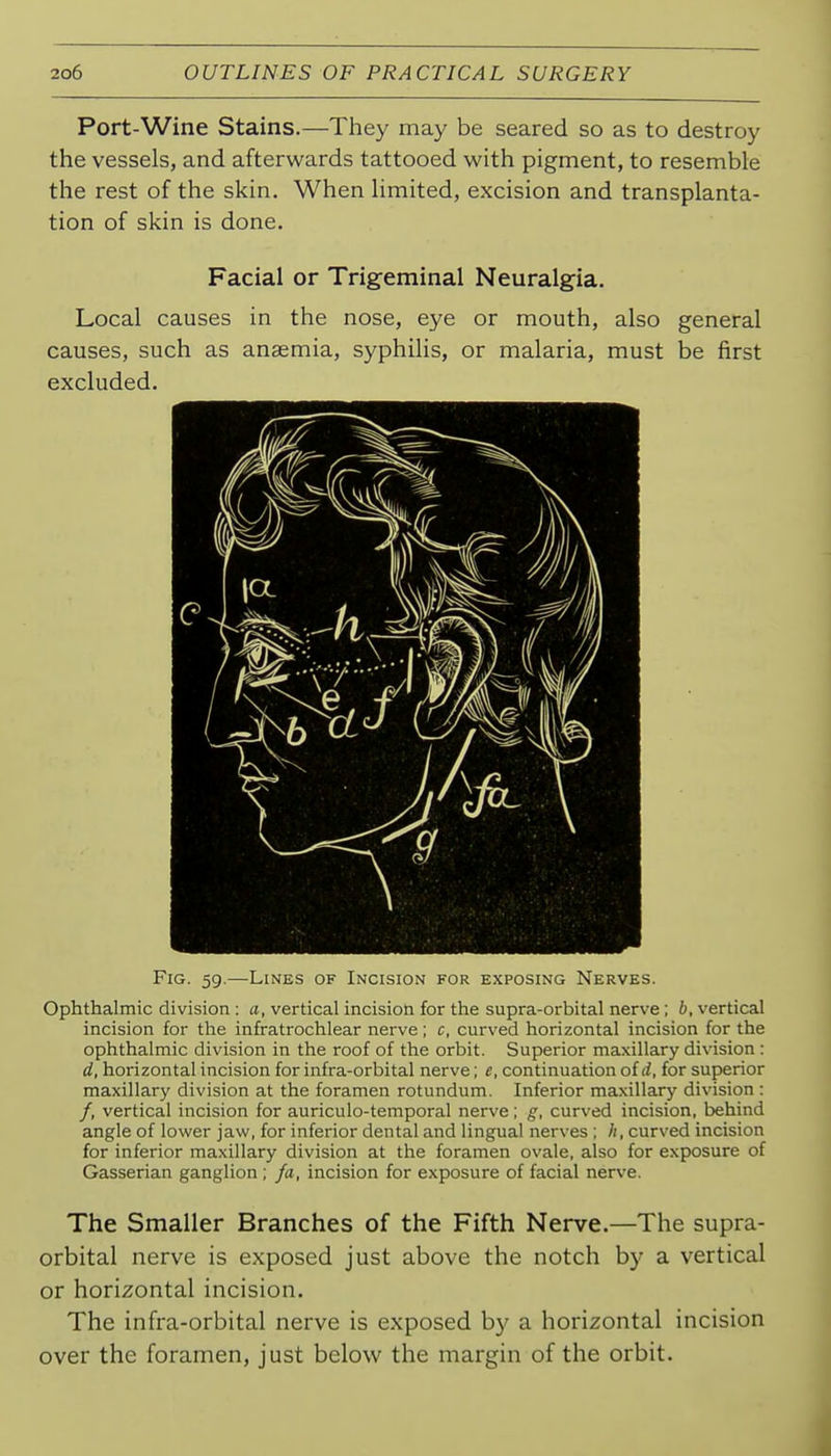 Port-Wine Stains.—They may be seared so as to destroy the vessels, and afterwards tattooed with pigment, to resemble the rest of the skin. When limited, excision and transplanta- tion of skin is done. Facial or Trigeminal Neuralgia. Local causes in the nose, eye or mouth, also general causes, such as anaemia, syphilis, or malaria, must be first excluded. Fig. 59.—Lines of Incision for exposing Nerves. Ophthalmic division : a, vertical incision for the supra-orbital nerve; b, vertical incision for the infratrochlear nerve; c, curved horizontal incision for the ophthalmic division in the roof of the orbit. Superior maxillary division : d, horizontal incision for infra-orbital nerve; e, continuation of rf, for superior maxillary division at the foramen rotundum. Inferior maxillary division : /, vertical incision for auriculo-temporal nerve; g, curved incision, behind angle of lower jaw, for inferior dental and lingual nerves; /(, curved incision for inferior maxillary division at the foramen ovale, also for exposure of Gasserian ganglion ; fa, incision for exposure of facial nerve. The Smaller Branches of the Fifth Nerve.—The supra- orbital nerve is exposed just above the notch by a vertical or horizontal incision. The infra-orbital nerve is exposed b}' a horizontal incision over the foramen, just below the margin of the orbit.