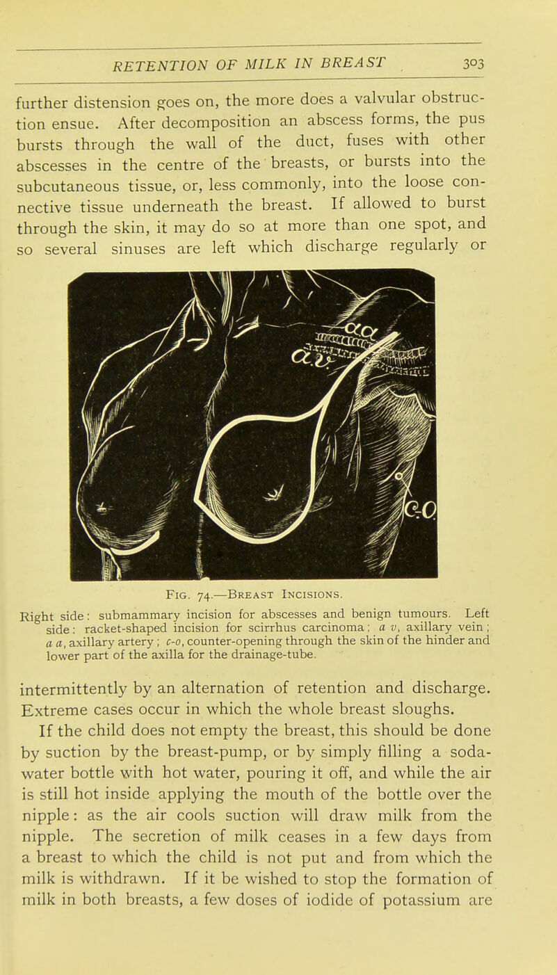 further distension ^oes on, the more does a valvular obstruc- tion ensue. After decomposition an abscess forms, the pus bursts through the wall of the duct, fuses with other abscesses in the centre of the breasts, or bursts into the subcutaneous tissue, or, less commonly, into the loose con- nective tissue underneath the breast. If allowed to burst through the skin, it may do so at more than one spot, and so several sinuses are left which discharge regularly or Fig. 74.—Breast Incisions. Right side: submammary incision for abscesses and benign tumours. Left side: racket-shaped incision for scirrhus carcinoma; a v, axillary vein ; a a, axillary artery ; c-o, counter-opening through the skin of the hinder and lower part of the axilla for the drainage-tube. intermittently by an alternation of retention and discharge. Extreme cases occur in which the whole breast sloughs. If the child does not empty the breast, this should be done by suction by the breast-pump, or by simply filling a soda- water bottle with hot water, pouring it off, and while the air is still hot inside applying the mouth of the bottle over the nipple: as the air cools suction will draw milk from the nipple. The secretion of milk ceases in a few days from a breast to which the child is not put and from which the milk is withdrawn. If it be wished to stop the formation of milk in both breasts, a few doses of iodide of potassium are