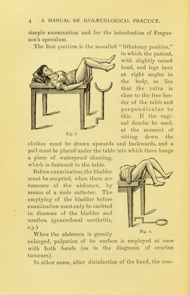 Fig. -3. simple examination and fox* the inti'oduction of Fergus- son's speculum. The first position is the so-called  lithotomy position, in which the patient, with slightly raised head, and legs bent at right angles to the body, so lies that the vulva is close to the free bor- der of the table aiid perpendicular to this. If the vagi- nal douche be used, at the moment of sitting down the clothes must be drawn upwards and backwards, and a pail must be placed under the table into which there hangs a piece of waterjDroof sheeting, which is fastened to the table. Before examination, the bladder must be emptied, when there are tumoui's of the abdomen, by means of a male catheter. The emptying of the bladder before examination must only be omitted in diseases of the bladder and urethi'a (gonorrhoea! urethritis, e.g.) When the abdomen is greatly enlarged, palpation of its surface is employed at once Avith both hands (as in the diagnosis of ovarian tumours). In other cases, after disinfection of the hand, the com-