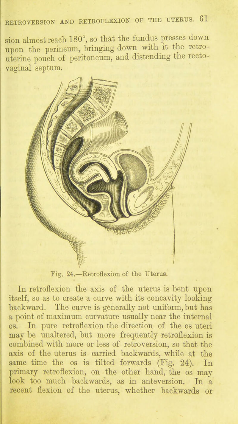 sion almost reach 180°, so that the fundus presses down upon the perineum, bringing doAvn with it the retro- uterine pouch of peritoneum, and distending the recto- vaginal septum. Fig. 24.—Retroflexion of the Uterus. In retroflexion the axis of the uterus is bent upon itself, so as to create a curve with its concavity looking backward. The curve is generally not uniform,but has a point of maximum curvature usually near the internal OS. In pure retroflexion the direction of the os uteri may be unaltered, but more frequently retroflexion is combined with more or less of retroversion, so that the axis of the uteras is carried backwards, while at the same time the os is tilted forwards (Fig. 24). In primary retroflexion, on the other hand,'the os may look too much backwards, as in anteversion. In a recent flexion of the uterus, whether backwards or