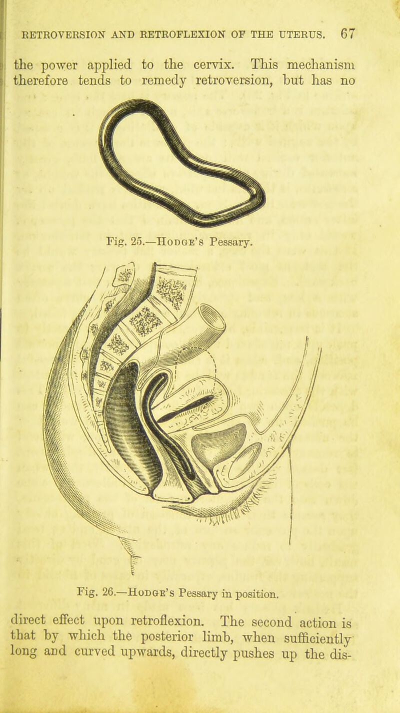 the power applied to the cervix. This mechanism therefore tends to remedy retroversion, but has no Fig. 25.—Hodge's Pessary. Fig. 26.—Hodge's Pessary in position. direct effect upon retroflexion. The second action is that by which the posterior limb, when sufficiently long and curved upwards, directly pushes up the dis-