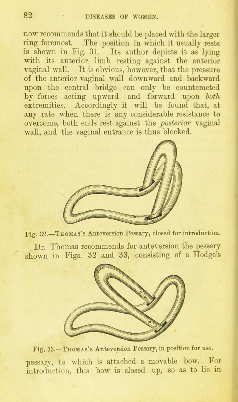 now recommends that it should be placed with the larger ring foremost. The position in which it usually rests is shown in Fig. 31. Its author depicts it as lying with its anterior limb resting against the anterior vaginal wall. It is obvious, however, that the pressure of the anterior vaginal waU downward and backward upon the central bridge can only be counteracted by forces acting upward and forward upon both extremities. Accordingly it wQl be found that, at any rate when there is any considerable resistance to overcome, both ends rest against the postenor vaginal waU, and the vaginal entrance is thus blocked. Fig. 32.—Thomas's Anteversion Pessary, closed for introduction. Dr. Thomas recommends for anteversion the pessary shown in Figs. 32 and 33, consisting of a Hodge's Fig. 33.—Thomas's Anteversion Pessary, in position for use. pessary, to which is attached a movable bow. For introduction, this bow is closed up, so as to lie in