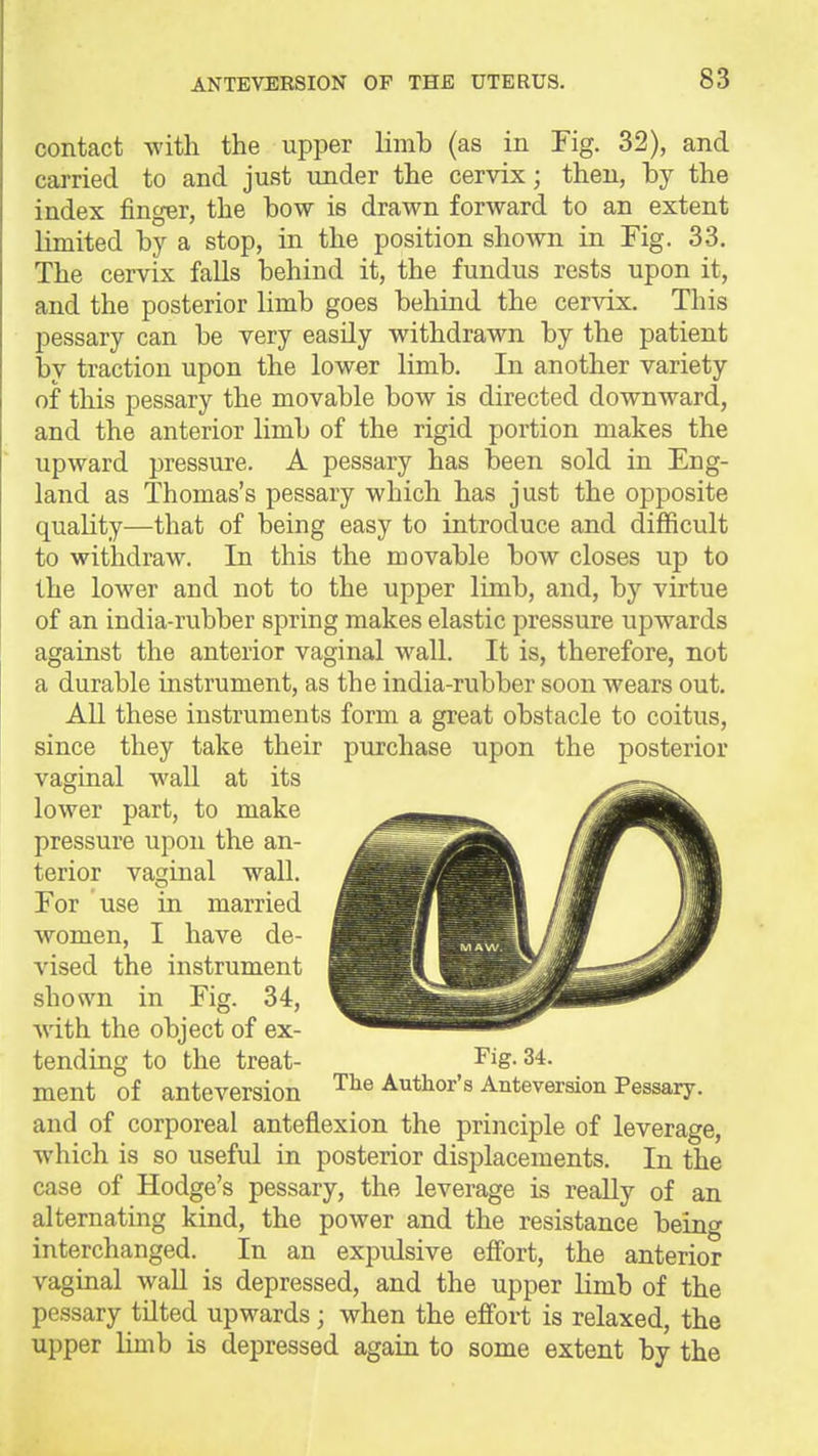 contact with the upper limb (as in Fig. 32), and carried to and just under the cervix; then, by the index finger, the bow is drawn forward to an extent limited by a stop, in the position shown in Fig. 33. The cervix falls behind it, the fundus rests upon it, and the posterior limb goes behind the cervix. This pessary can be very easdy withdrawn by the patient by traction upon the lower limb. In another variety of this pessary the movable bow is directed downward, and the anterior limb of the rigid portion makes the upward pressure. A pessary has been sold in Eng- land as Thomas's pessary which has just the opposite quality—that of being easy to introduce and difficult to withdraw. In this the movable bow closes up to the lower and not to the upper limb, and, by virtue of an india-rubber spring makes elastic pressure upwards against the anterior vaginal Avail. It is, therefore, not a durable instrument, as the india-rubber soon wears out. All these instruments form a great obstacle to coitus, since they take their purchase upon the posterior vaginal wall at its lower part, to make pressure upon the an- terior vaginal wall. For use in married women, I have de- vised the instrument shown in Fig. 34, with the object of ex- tending to the treat- Fig. 34. ment of anteversion The Author's Anteveraion Pessary, and of corporeal anteflexion the principle of leverage, which is so useful in posterior displacements. In the case of Hodge's pessary, the leverage is really of an alternating kind, the power and the resistance being interchanged. In an expulsive effort, the anterior vaginal wall is depressed, and the upper limb of the pessary tUted upwards; when the eff'ort is relaxed, the upper limb is depressed again to some extent by the