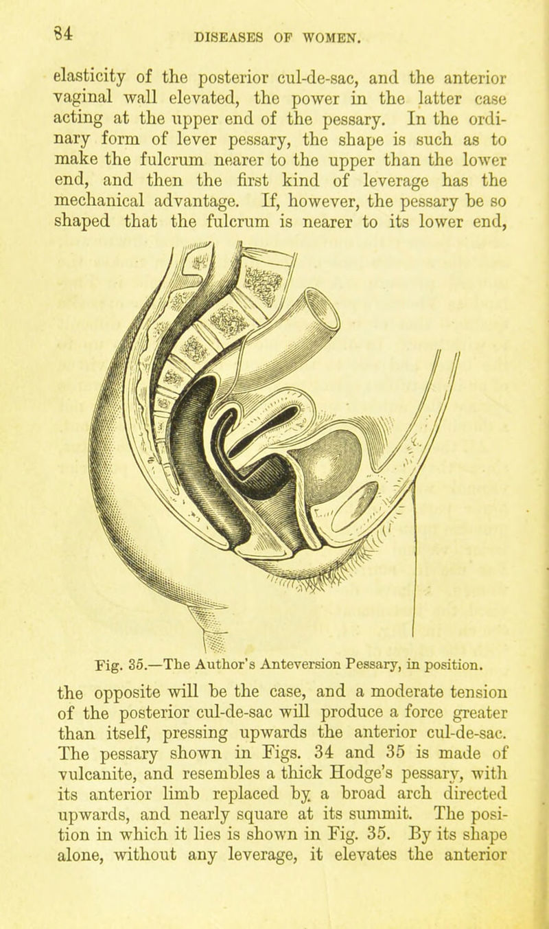 elasticity of the posterior cul-de-sac, and the anterior vaginal wall elevated, the power in the latter case acting at the npper end of the pessary. In the ordi- nary form of lever pessary, the shape is such as to make the fulcrum nearer to the upper than the lower end, and then the first kind of leverage has the mechanical advantage. If, however, the pessary be so shaped that the fulcrum is nearer to its lower end, Fig. 35.—The Author's Anteversion Pessary, in position. the opposite will he the case, and a moderate tension of the posterior cul-de-sac will produce a force greater than itself, pressing upwards the anterior cul-de-sac. The pessary shown in Figs. 34 and 35 is made of vulcanite, and resembles a thick Hodge's pessary, with its anterior limb replaced by. a broad arch directed upwards, and nearly square at its summit. The posi- tion in which it lies is shown in Fig. 35. By its shape alone, without any leverage, it elevates the anterior