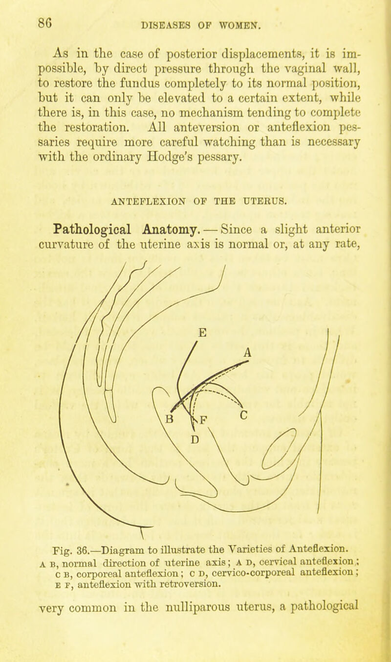 As in the case of posterior displacements, it is im- possible, by direct pressure through the vaginal wall, to restore the fundus completely to its normal position, but it can only be elevated to a certain extent, while there is, in this case, no mechanism tending to complete the restoration. All anteversion or anteflexion pes- saries require more careful watching than is necessary with the ordinary Hodge's pessary. ANTEFLEXION OP THE UTERUS. Pathological Anatomy. — Since a slight anterior curvature of the uterine axis is normal or, at any rate, Fig. 36.—Diagram to illustrate the Varieties of Anteflexion. A B, normal direction of uterine axis; A d, cervical anteflexion ; c B, corporeal anteflexion; c d, cervico-corporeal anteflexion ; E F, anteflexion with retroversion. very common in the nulliparous uterus, a pathological