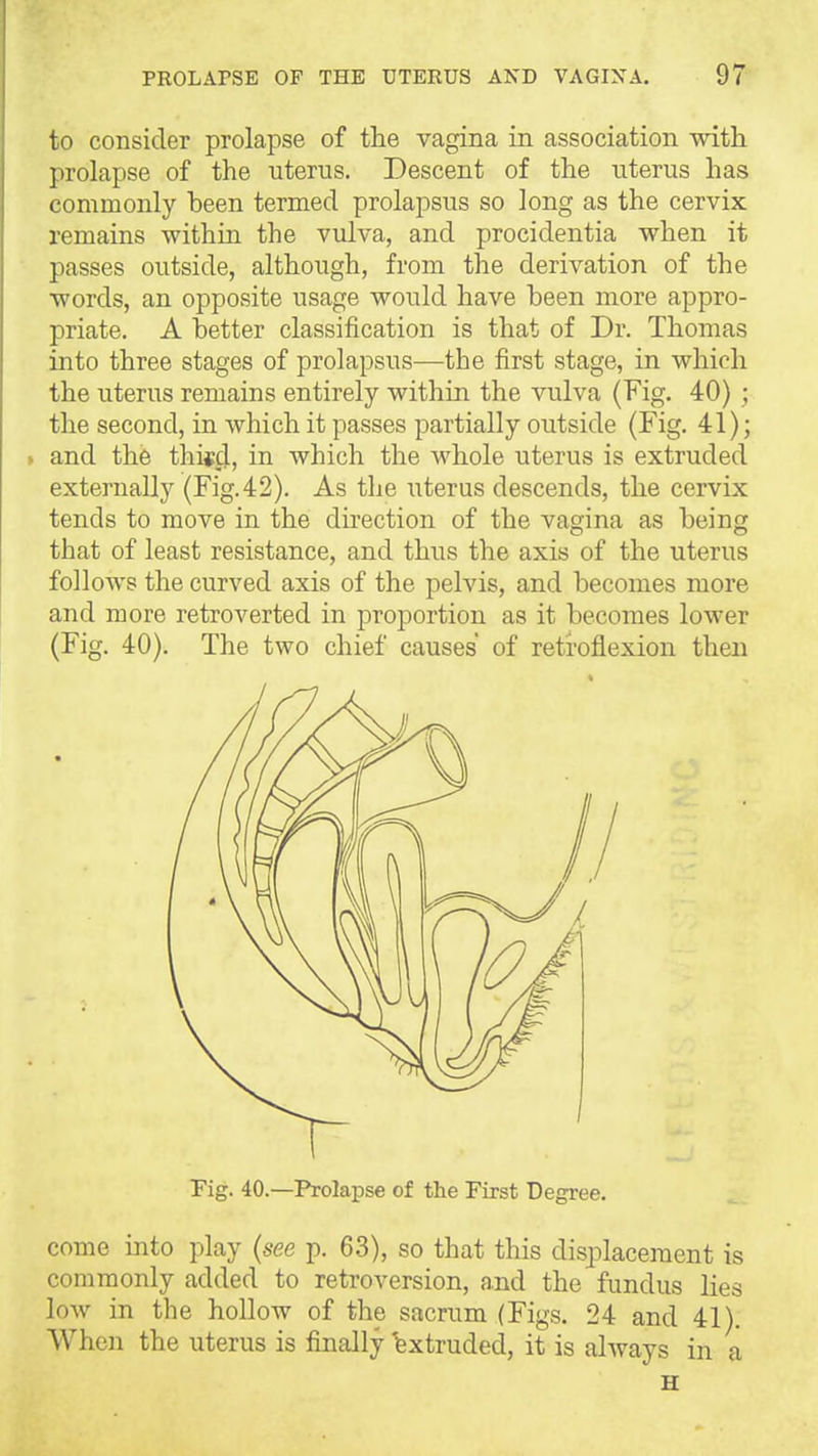 to consider prolapse of the vagina in association with prolapse of the uterus. Descent of the uterus has commonly been termed prolapsus so long as the cervix remains within the vulva, and procidentia when it passes outside, although, from the derivation of the words, an opposite usage would have been more appro- priate. A better classification is that of Dr. Thomas into three stages of prolapsus—the first stage, in which the uterus remains entirely within the vulva (Fig. 40) ; the second, in which it passes partially outside (Fig. 41); . and the thisd, in which the whole uterus is extruded externally (Fig.42). As the uterus descends, the cervix tends to move in the direction of the vagina as being that of least resistance, and thus the axis of the uterus follows the curved axis of the pelvis, and becomes more and more retroverted in proportion as it becomes lower (Fig. 40). The two chief causes of retroflexion then Fig. 40.—Prolapse of the First Degree. come into play (see p. 63), so that this displacement is commonly added to retroversion, and the fundus lies low in the hollow of the sacrum (Figs. 24 and 41). When the uterus is finally Extruded, it is always in a H