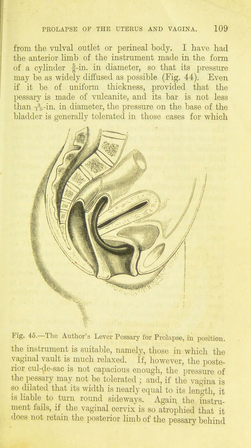 from the vulval outlet or perineal body. I have had the anterior Umb of the instrument made in the form of a cylinder f-in. in diameter, so that its pressure may be as widely diffused as possible (Fig. 44). Even if it be of uniform tliickness, provided that the pessary is made of vulcanite, and its bar is not less than 1:1,-in. in diameter, the pressure on the base of the bladder is generally tolerated in those cases for which Fig. 46.—The Author's Lever Pessary for Prolapse, in position, the instrument is suitable, namely, those in which the vaginal vault is much relaxed. If, however, the poste- rior cid-de-sac is not capacious enough, the pressure of the pessary may not be tolerated ; and, if the vagina is so dilated that its width is nearly equal to its length, it is liable to turn round sideways. Again the instru- ment fails, if the vaginal cervix is so atrophied that it does not retain the posterior lunb of the pessary behind