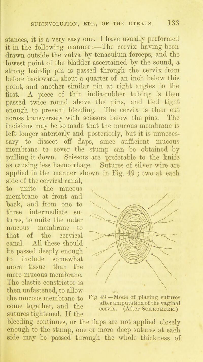 stances, it is a very easy one. I have usnally performed it in the following manner :—The cervix having been drawn outside the vulva by tenaculum forceps, and the ■ lowest point of the bladder ascertained by the sound, a strong hair-lip pin is passed through the cervix from before backward, about a quarter of an inch below this point, and another similar pin at right angles to the first. A piece of thin india-rubber tubing is then passed twice round above the pins, and tied tight enough to prevent bleeding. The cervix is then cut across transversely with scissors below the pins. The incisions may be so made that the mucous membrane is left longer anteriorly and posteriorly, but it is unneces- sary to dissect off flaps, since sufficient mucous membrane to cover the stump can be obtained by puUing it down. Scissors are preferable to the knife as causing less htemorrhage. Sutures of silver wire are applied in the manner shown in Fig. 49 ; two at each side of the cervical canal, to unite the mucous membrane at front and back, and from one to three intermediate su- tures, to unite the outer mucous membrane to that of the cervical canal. All these should be passed deeply enough to include somewhat more tissue than the mere mucous membrane. The elastic constrictor is then unfastened, to allow the mucous membrane to come together, and the sutures tightened. If the bleeding continues, or the flaps are not applied closely enough to the stump, one or more deep sutures at each side may be passed through the whole thickness of Fig 49 —Mode of plaoina: sutures nf ter amputation of the vaginal cervix. (After Schroeder.)