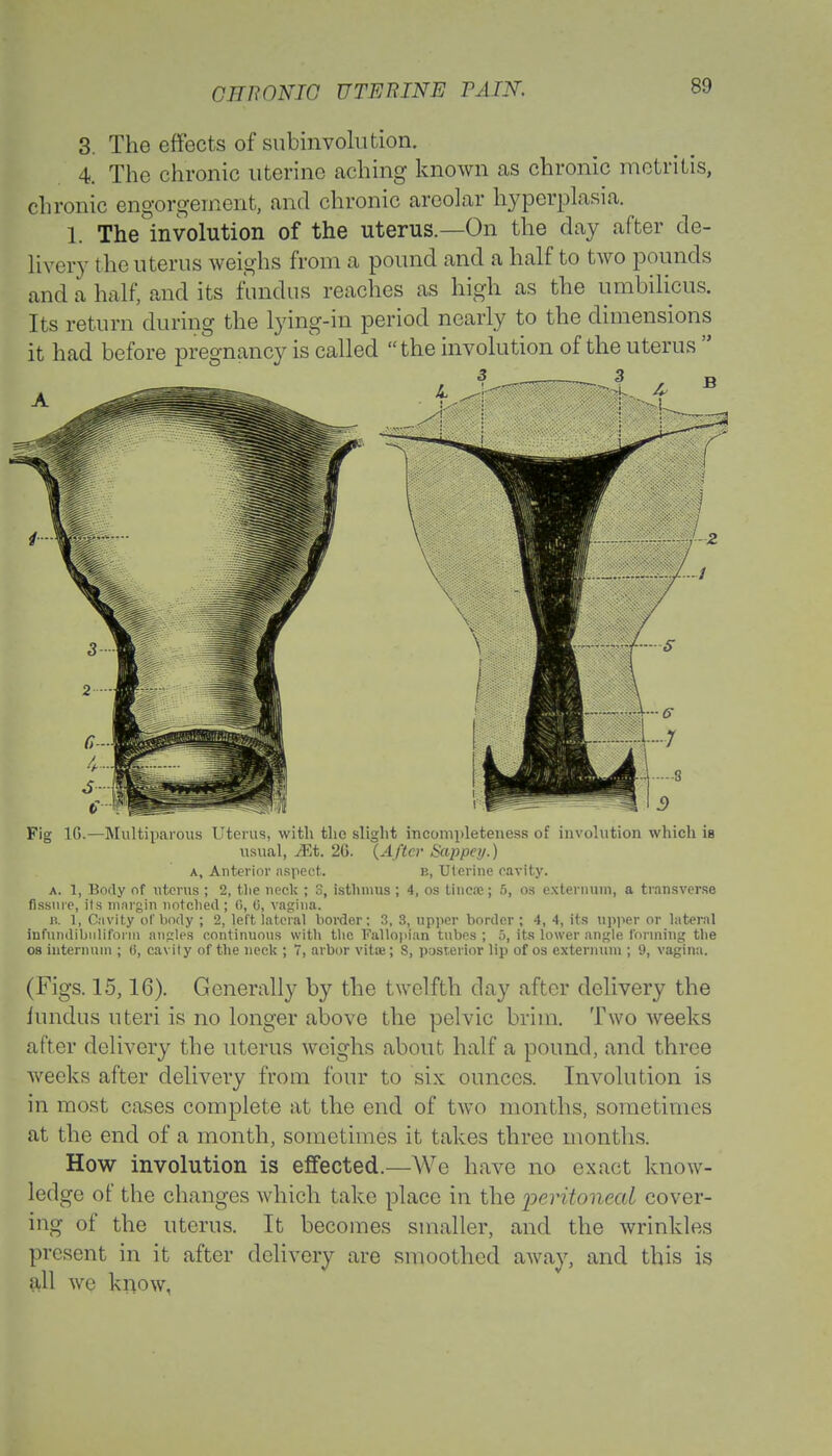 3. The effects of subinvolution. 4. The chronic uterine aching known as chronic metritis, chronic engorgement, and chronic areolar hyperplasia. 1. The involution of the uterus—On the day after de- livery the uterus weighs from a pound and a half to two pounds and a half, and its fundus reaches as high as the umbilicus. Its return during the lying-in period nearly to the dimensions it had before pregnancy is called the involution of the uterus  Fig 1G.—Multiparous Uterus, with the slight incompleteness of involution which is usual, iEt. 2G. (After Sappey.) a, Anterior aspect. e, Uterine cavity. a. 1, Body of uterus ; 2, t-lie neck ; S, isthmus ; 4, os tinea:; 5, os externum, a transverse fissure, its margin notched; 6, 0, vagina. n. 1, Cavity of body ; 2, left lateral border; 3, 3, upper border ; 4, 4, its upper or lateral infundibnlifoini angles continuous with the Fallopian tubf>s ; o, its lower angle forming the os internum ; (i, cavity of the neck ; 7, arbor vita;; S, posterior lip of os externum ; 9, vagina. (Figs. 15,16). Generally by the twelfth day after delivery the fundus uteri is no longer above the pelvic brim. Two weeks after delivery the uterus weighs about half a pound, and three weeks after delivery from four to six ounces. Involution is in most cases complete at the end of two months, sometimes at the end of a month, sometimes it takes three months. How involution is effected.—We have no ox art know- ledge of the changes which take place in the peritoneal cover- ing of the uterus. It becomes smaller, and the wrinkles present in it after delivery are smoothed away, and this is all we know,