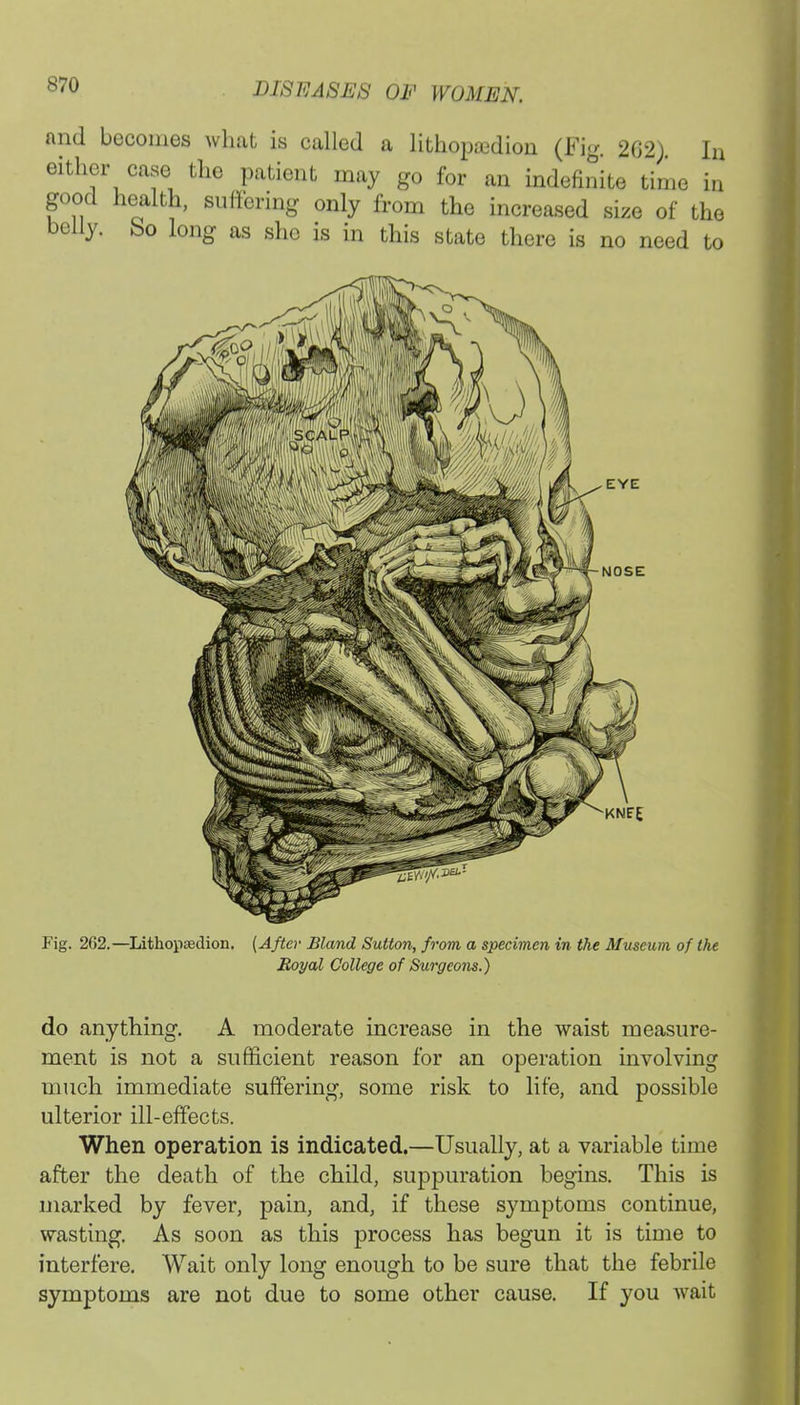 and becomes what is called a lithopjedion (Fig. 202) In either case the patient may go for an indefinite time in good health, suffering only from the increased size of the belly, bo long as she is in this state there is no need to Fig. 262.—Lithopaedion. (After Bland Sutton, from a specimen in the Museum of the Royal College of Surgeons.) do anything. A moderate increase in the waist measure- ment is not a sufficient reason for an operation involving much immediate suffering, some risk to life, and possible ulterior ill-effects. When operation is indicated.—Usually, at a variable time after the death of the child, suppuration begins. This is marked by fever, pain, and, if these symptoms continue, wasting. As soon as this process has begun it is time to interfere. Wait only long enough to be sure that the febrile symptoms are not due to some other cause. If you wait