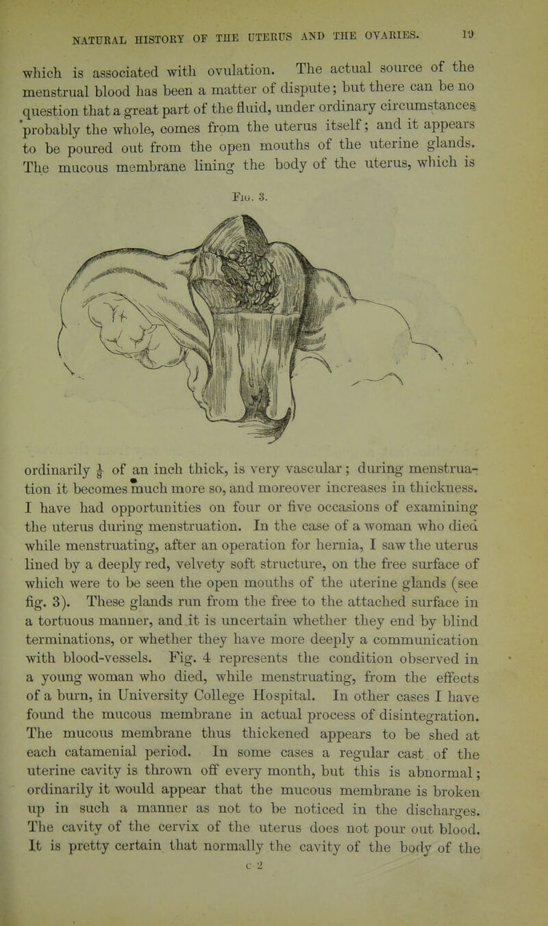 which is associated with ovulation. The actual source of the menstrual blood has been a matter of dispute; but there can be no question that a great part of the fluid, under ordinary circumstances, 'probably the whole, comes from the uterus itself; and it appears to be poured out from the open mouths of the uterine glands. The mucous membrane lining the body of the uterus, which is Fiii. 3. ordinarily ^ of an inch thick, is very vascular; dming menstrua- tion it becomes much more so, and moreover increases in thickness. I have had opportunities on four or five occasions of examining the uterus dming menstruation. In the case of a woman who died while menstruating, after an operation for hernia, I saw the uterus lined by a deeply red, velvety soft structure, on the free surface of which were to be seen the open mouths of the uterine glands (see fig. 3). These glands run from the free to the attached surface in a tortuous manner, and it is uncertain whether they end by blind terminations, or whether they have more deeply a communication with blood-vessels. Fig. 4 represents the condition observed in a young woman who died, while menstruating, from the effects of a bm-n, in University College Hospital. In other cases I have found the mucous membrane in actual process of disintegration. The mucous membrane thus thickened appears to be shed at each catamenial period. In some cases a regular cast of the uterine cavity is thrown off every month, but this is abnormal; ordinarily it would appear that the mucous membrane is broken up in such a manner as not to be noticed in the discharges. The cavity of the cervix of the uterus does not pour out blood. It is pretty certain that normally the cavity of the body of the