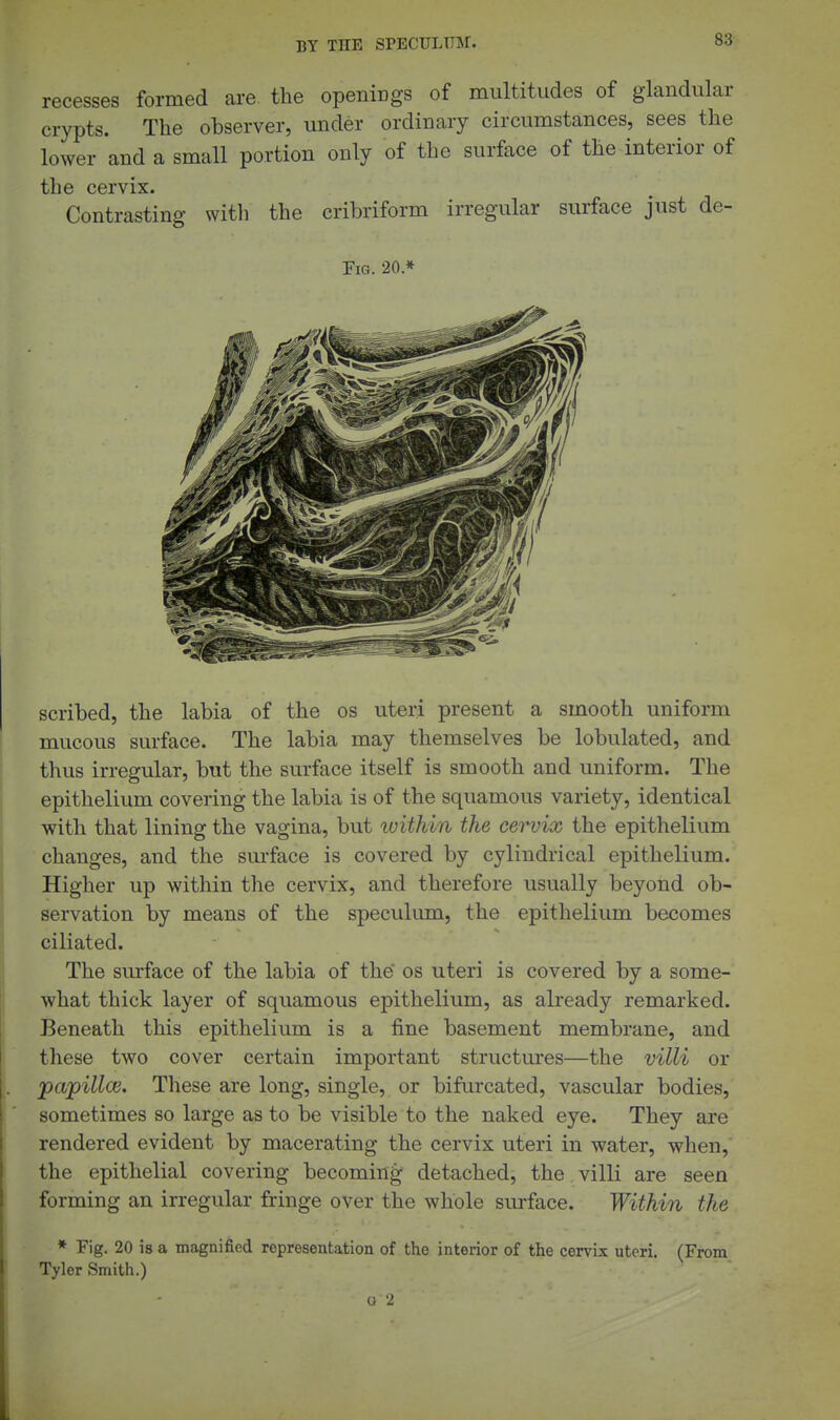 recesses formed are the openiDgs of multitudes of glandular crypts. The observer, under ordinary circumstances, sees the lower and a small portion only of the surface of the interior of the cervix. Contrasting witli the cribriform irregular surface just de- FiG. 20* scribed, the labia of the os uteri present a smooth uniform mucous surface. The labia may themselves be lobulated, and thus irregular, but the surface itself is smooth and uniform. The epithelium covering the labia is of the squamous variety, identical with that lining the vagina, but luithin the cervix the epithelium changes, and the surface is covered by cylindrical epithelium. Higher up within the cervix, and therefore usually beyond ob- servation by means of the speculum, the epithelium becomes ciliated. The surface of the labia of the os uteri is covered by a some- what thick layer of squamous epithelium, as already remarked. Beneath this epithelium is a fine basement membrane, and these two cover certain important structm'es—the villi or pajpillce. These are long, single, or bifurcated, vascular bodies, sometimes so large as to be visible to the naked eye. They are rendered evident by macerating the cervix uteri in water, when, the epithelial covering becoming detached, the villi are seen forming an irregular fringe over the whole surface. Within the * Fig. 20 is a magnified representation of the interior of the cervix uteri. Tyler Smith.) o '2 (From L