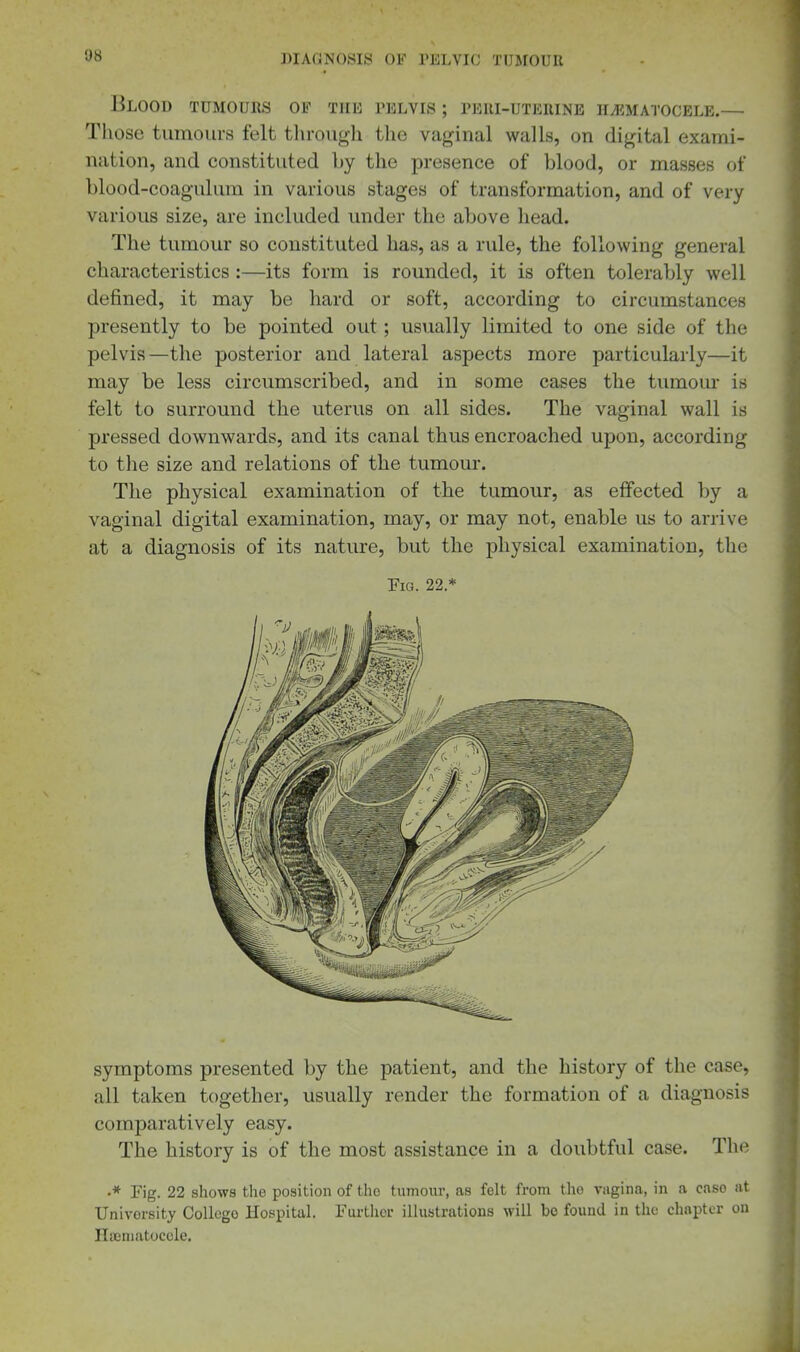 08 Blood tumours of the pelvis ; peri-uterine IlyRMATOCELE.— Those tumours felt through the vaginal walls, on digital exami- nation, and constituted by the presence of blood, or masses of blood-coagulum in various stages of transformation, and of very various size, are included under the above head. The tumour so constituted has, as a rule, the following general characteristics :—its form is rounded, it is often tolerably well defined, it may be hard or soft, according to circumstances presently to be pointed out; usually limited to one side of the pelvis—the posterior and lateral aspects more particularly—it may be less circumscribed, and in some cases the tumom* is felt to surround the uterus on all sides. The vaginal wall is pressed downwards, and its canal thus encroached upon, according to the size and relations of the tumour. The physical examination of the tumour, as effected by a vaginal digital examination, may, or may not, enable us to arrive at a diagnosis of its nature, but the physical examination, the Fig. 22 * symptoms presented by the patient, and the history of the case, all taken together, usually render the formation of a diagnosis comparatively easy. The history is of the most assistance in a doubtful case. The •* Fig. 22 shows the position of the tumour, as felt from the vagina, in a case at University College Hospital. Further illustrations will be found in the chapter on Hainiatocole.