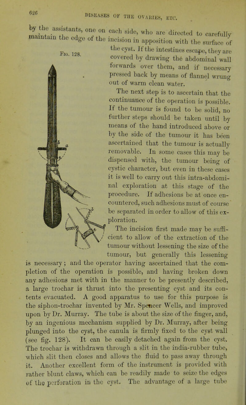 DISEASES OF THE OVAUIES, ETC Fio. 128. mamtain the edge of the incision in apposition with the surface of the cyst. If the intestines escape, they are covered Ly drawing th6 abdominal wall forwards over them, and if necessary pressed back by means of flannel wrung out of warm clean water. The next step is to ascertain that the continuance of the operation is possible. If the tumour is found to be solid, no further steps should be taken until by means of the hand introduced above or by the side of the tumour it has been ascertained that the tumour is actually removable. In some cases this may be dispensed with, the tumom- being of cystic character, but even in these cases it is well to carry out this intra-abdomi- nal exploration at this stage of the procedure. If adhesions be at once en- countered, such adhesions must of course be separated in order to allow of this ex- ploration. The incision first made may be suffi- cient to allow of the extraction of the tumour without lessening the size of the tumour, but generally this lessening- is necessary; and the operator having ascertained that the com- pletion of the operation is possible, and having broken down any adhesions met with in the manner to be presently described, a large trochar is thrust into the presenting cyst and its con- tents evacuated. A good apparatus to use for this purpose is the siphon-trochar invented by Mr. Spencer Wells, and improved upon by Dr. Murray. The tube is about the size of tlie finger, and, by an ingenious mechanism supplied by Dr. Murray, after being plunged into the cyst, the canula is firmly fixed to the cyst wall (see fig. 128). It can be easily detached again from the cyst. The trochar is withdrawn through a slit in the india-rubber tube, which slit then closes and allows the fluid to pass away through it. Another excellent form of the instrument is provided with rather blunt claws, which can be readily made to seize the edges of the perforation in the cyst. The advantage of a large tube