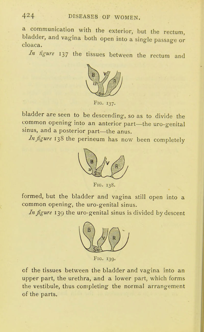 a communication with tiie exterior, but the rectum, bladder, and va^rina both open into a single passage or cloaca. In figure 137 the tissues between the rectum and Fig. 137. bladder are seen to be descending, so as to divide the common opening into an anterior part—the uro-genital sinus, and a posterior part—the anus. Lifigure 138 the perineum has now been completely Fig. 138. formed, but the bladder and vagina still open into a common opening, the uro-genital sinus. In figure 139 the uro-genital sinus is divided by descent of the tissues between the bladder and vagina into an upper part, the urethra, and a lower part, which forms the vestibule, thus completing the normal arrangement of the parts.