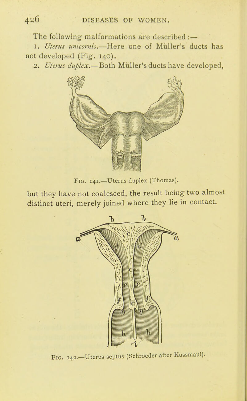 The following- malformations are described: — 1. Uterus tmicor?ns.—Here one of Miiller's ducts has not developed (Fig. 140). 2. Uterus duplex,—Both Miiller's ducts have developed, Fig, 141.—Uterus duplex (Thomas). but they have not coalesced, the result being- two almost distinct uteri, merely joined where they lie in contact. Fig. 142.—Uterus septus (Schroeder after Kussmaul).