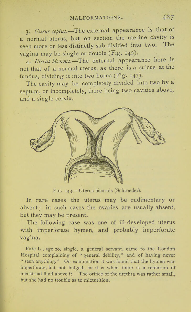 3. W^rwj jf^/ttJ.—The external appearance is that of a normal uterus, but on section the uterine cavity is seen more or less distinctly sub-divided into two. The vagina may be single or double (Fig. 142). 4. Uterus bicorm's—The external appearance here is not that of a normal uterus, as there is a sulcus at the fundus, dividing it into two horns (Fig, 143). The cavity may be completely divided into two by a septum, or incompletely, there being two cavities above, and a single cervix. Fig. 143.—Uterus bicornis (Schroeder). In rare cases the uterus may be rudimentary or absent; in such cases the ovaries are usually absent, but they may be present. The following case was one of ill-developed uterus with imperforate hymen, and probably imperforate vagina. Kate L., age 20, single, a general servant, came to the London Hospital complaining of  general debility, and of having never  seen anything. On examination it v^'as found that the hymen was imperforate, but not bulged, as it is when there is a retention of menstrual fluid above it. The orifice of the urethra was rather small, but she had no trouble as to micturition.