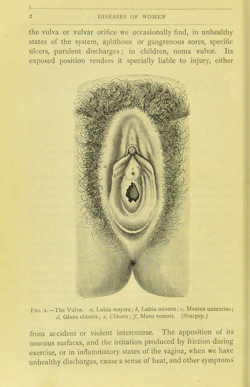 the vulva or vulvar orifice we occasionally find, in unhealthy states of the system, aphthous Or gangrenous sores, specific ulcers, purulent discharges; in children, noma vulvae. Its exposed position renders it specially liable to injury, either Fig. i. —The Vulva, a, Labia majora; b, Labia minora; c, Meatus uninarius; d, Glans clitoris ; c, Clitoris ; /, Mons veneris. (Sharpey.) from accident or violent intercourse. The apposition of its mucous surfaces, and the irritation produced by friction during exercise, or in inflammatory states of the vagina, when we have unhealthy discharges, cause a sense of heat, and other symptoms