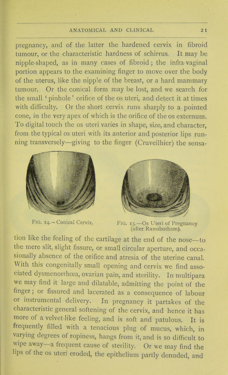 pregnancy, and of the latter the hardened cervix in fibroid tumour, or the characteristic hardness of schirrus. It may be nipple-shaped, as in many cases of fibroid; the infra-vaginal portion appears to the examining finger to move over the body of the uterus, like the nipple of the breast, or a hard mammary tumour. Or the conical form may be lost, and we search for the small ' pinhole ' orifice of the os uteri, and detect it at times with difficulty. Or the short cervix runs sharply to a pointed cone, in the very apex of which is the orifice of the os externum. To digital touch the os uteri varies in shape, size, and character, from the typical os uteri with its anterior and posterior lips run- ning transversely—giving to the finger (Cruveilhier) the sensa- Fig. 14.-Conical Cervix. Fig. 15.— Os Uteri of Pregnancy (after Ramsbolham). Hon like the feeling of the cartilage at the end of the nose—to the mere slit, slight fissure, or small circular aperture, and occa- sionally absence of the orifice and atresia of the uterine canal. With this congenitally small opening and cervix we find asso- ciated dysmenorrhcea, ovarian pain, and sterility. In multipara we may find it large and dilatable, admitting the point of the finger; or fissured and lacerated as a consequence of labour or instrumental delivery. In pregnancy it partakes of the characteristic general softening of the cervix, and hence it has more of a velvet-like feeling, and is soft and patulous. It is frequently filled with a tenacious plug of mucus, which, in varying degrees of ropiness, hangs from it, and is so difficult to wipe away—a frequent cause of sterility. Or we may find the lips of the os uteri eroded, the epithelium partly denuded, and