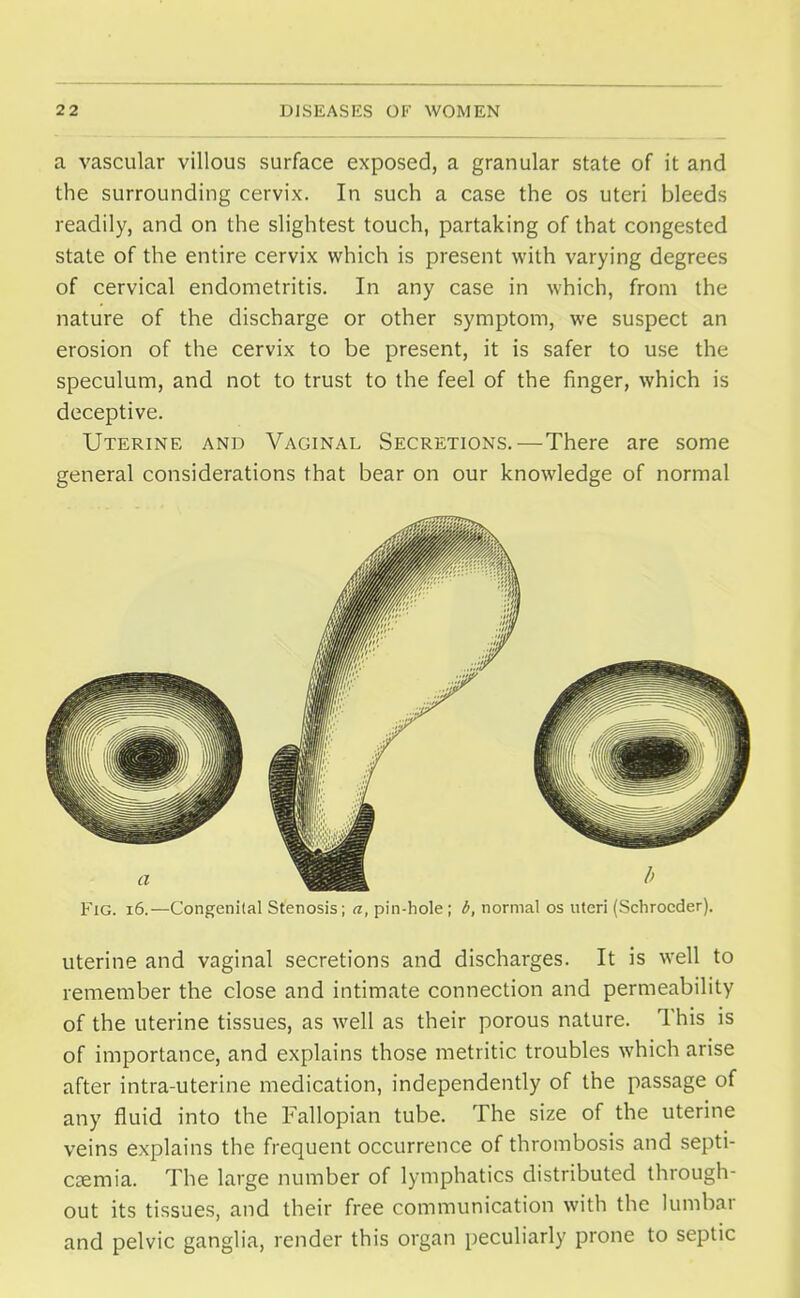 a vascular villous surface exposed, a granular state of it and the surrounding cervix. In such a case the os uteri bleeds readily, and on the slightest touch, partaking of that congested state of the entire cervix which is present with varying degrees of cervical endometritis. In any case in which, from the nature of the discharge or other symptom, we suspect an erosion of the cervix to be present, it is safer to use the speculum, and not to trust to the feel of the finger, which is deceptive. Uterine and Vaginal Secretions.—There are some general considerations that bear on our knowledge of normal Fig. 16.—Congenital Stenosis; a, pin-hole; b, normal os uteri (Schrocder). uterine and vaginal secretions and discharges. It is well to remember the close and intimate connection and permeability of the uterine tissues, as well as their porous nature. This is of importance, and explains those metritic troubles which arise after intra-uterine medication, independently of the passage of any fluid into the Fallopian tube. The size of the uterine veins explains the frequent occurrence of thrombosis and septi- caemia. The large number of lymphatics distributed through- out its tissues, and their free communication with the lumbar and pelvic ganglia, render this organ peculiarly prone to septic