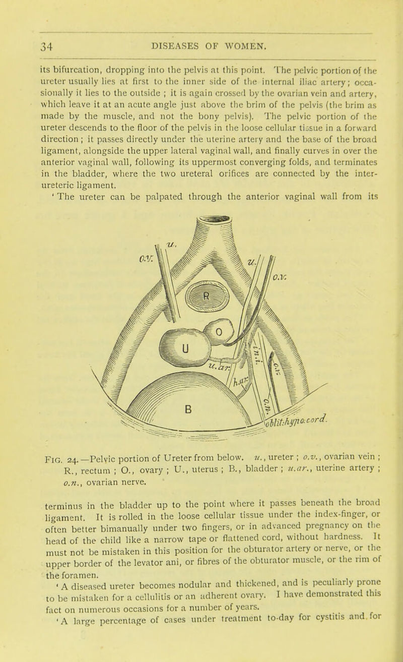 its bifurcation, dropping into the pelvis at this point. The pelvic portion of the ureter usually lies at first to the inner side of the internal iliac artery; occa- sionally it lies to the outside ; it is again crossed by the ovarian vein and artery, which leave it at an acute angle just above the brim of the pelvis (the brim as made by the muscle, and not the bony pelvis). The pelvic portion of the ureter descends to the floor of the pelvis in the loose cellular tissue in a forward direction ; it passes directly under the uterine artery and the base of the broad ligament, alongside the upper lateral vaginal wall, and finally curves in over the anterior vaginal wall, following its uppermost converging folds, and terminates in the bladder, where the two ureteral orifices are connected by the inter- ureteric ligament. ' The ureter can be palpated through the anterior vaginal wall from its Fig. 24.—Pelvic portion of Ureter from below, u., ureter ; o.v., ovarian vein ; R., rectum ; O., ovary ; U., uterus ; B., bladder ; it.or., uterine artery ; o.n., ovarian nerve. terminus in the bladder up to the point where it passes beneath the broad ligament. It is rolled in the loose cellular tissue under the index-finger, or often better bimanually under two fingers, or in advanced pregnancy on the head of the child like a narrow tape or flattened cord, without hardness. It must not be mistaken in this position for the obturator artery or nerve, or the upper border of the levator ani, or fibres of the obturator muscle, or the rim of the foramen. 'A diseased ureter becomes nodular and thickened, and is peculiarly prone to be mistaken for a cellulitis or an adherent ovary. I have demonstrated this fact on numerous occasions for a number of years. •A large percentage of cases under treatment to-day for cystitis and. for