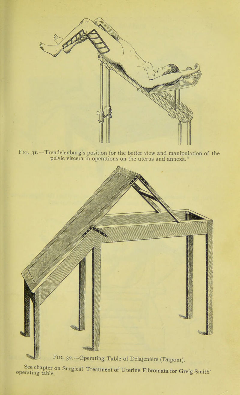 FlG. 31.—Trendelenburg's position for the better view and manipulation of the pelvic viscera in operations on the uterus and annexa.* 32.—Operating Table of Delajeniere (Dupont). opeSingTbTe.0 SUrg''Cal Treatment of Uterine Fibromata for Greig Smith'