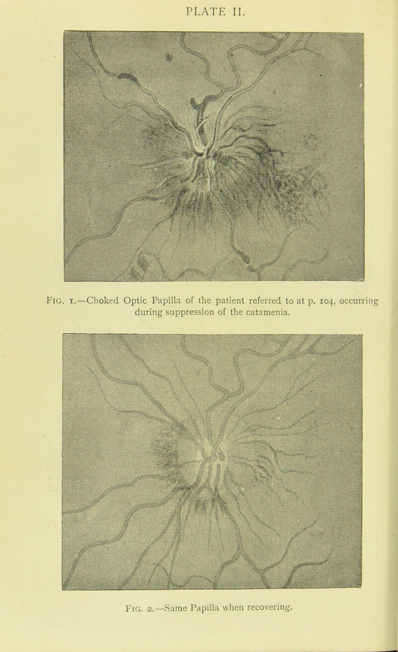 Fig. 2.—Same Papilla when recovering.